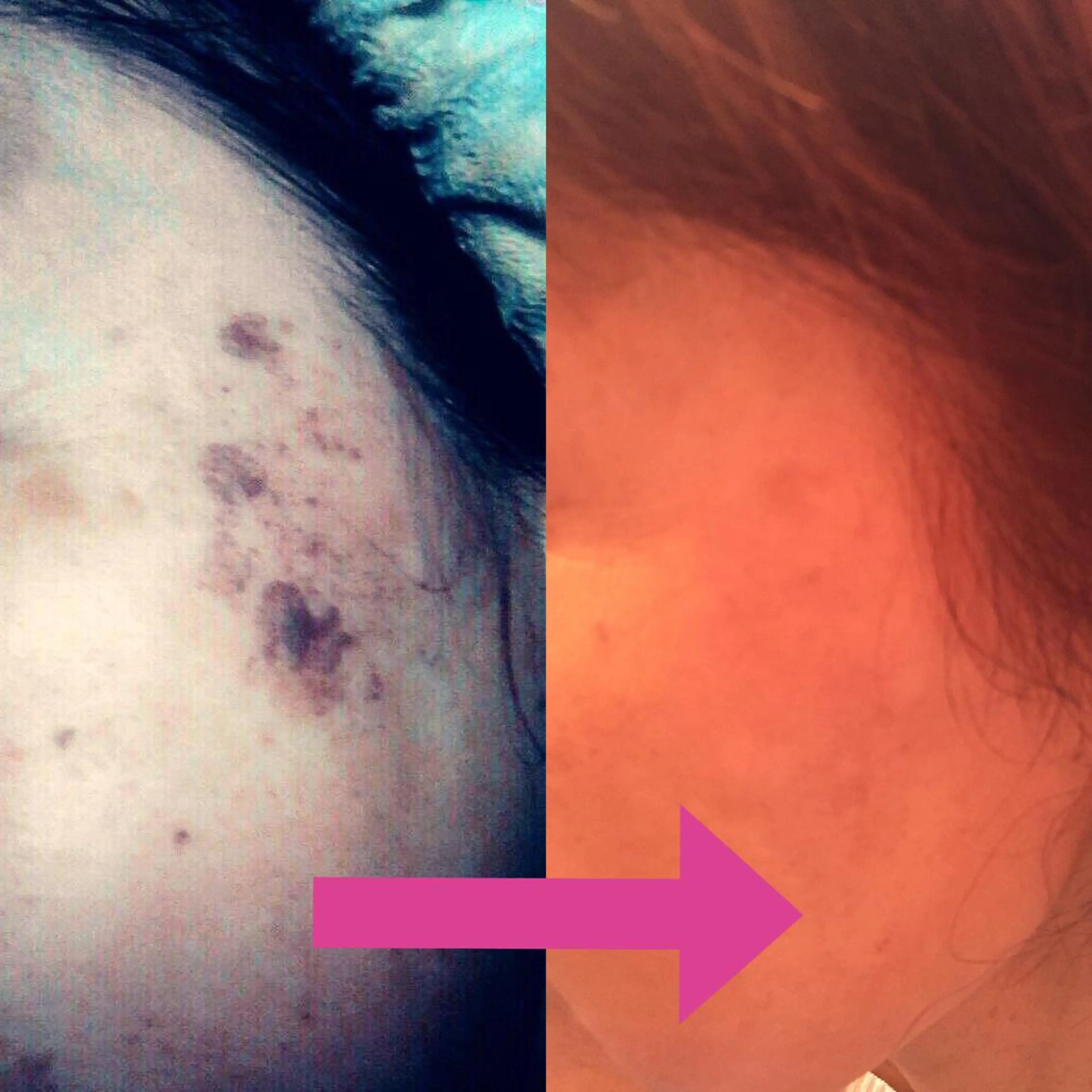 【1番人気完全お任せ✨】毛穴洗浄+光フェイシャル+顔脱毛+ぷるぷる海藻パックまでついた超贅沢コースの写真