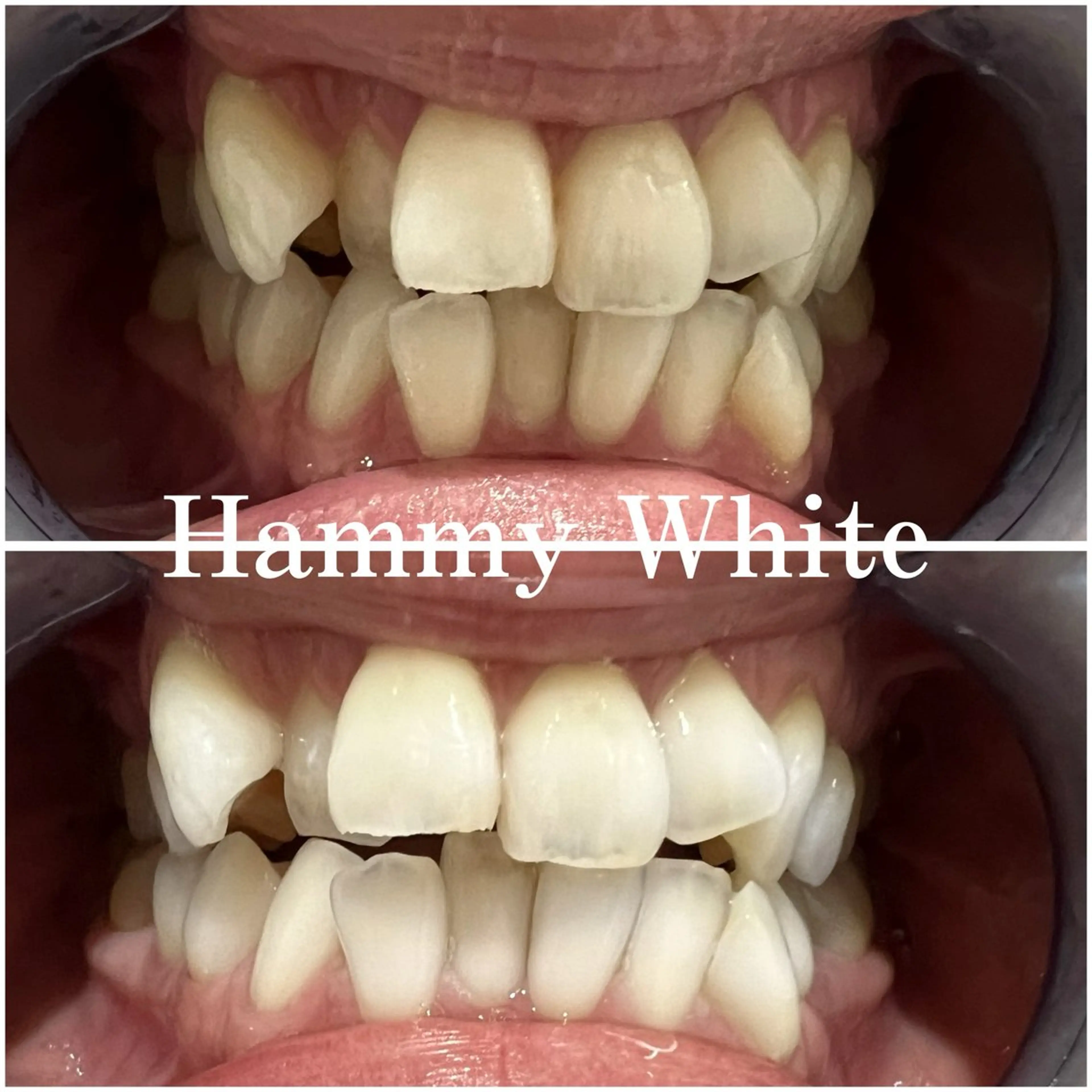 【歯科提携】高濃度ジェルセルフホワイトニング連続照射30分¥7000→¥5000🦷✨の写真