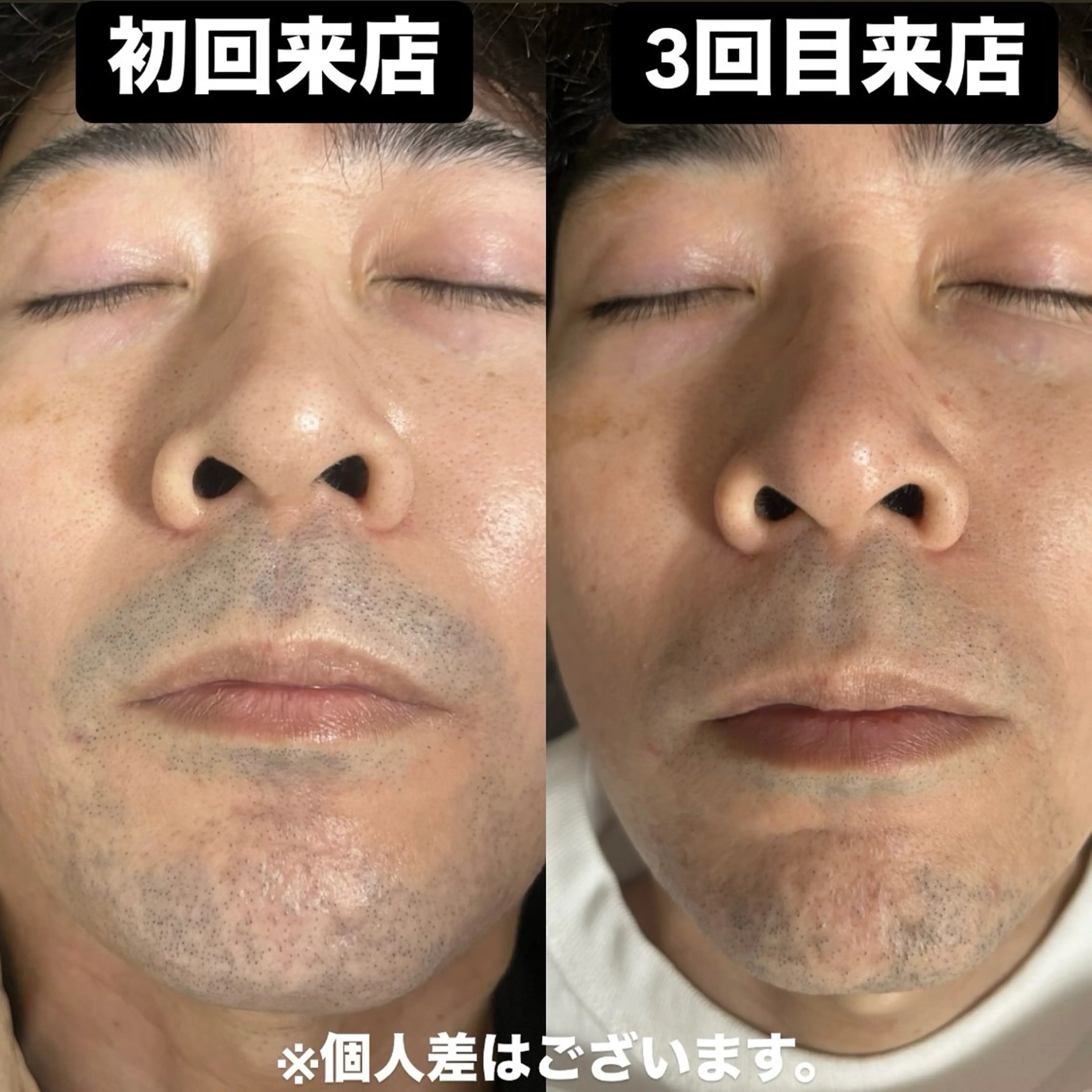 普段の処理をなくすために【メンズ脱毛】ヒゲ脱毛初回お試し1500円の写真