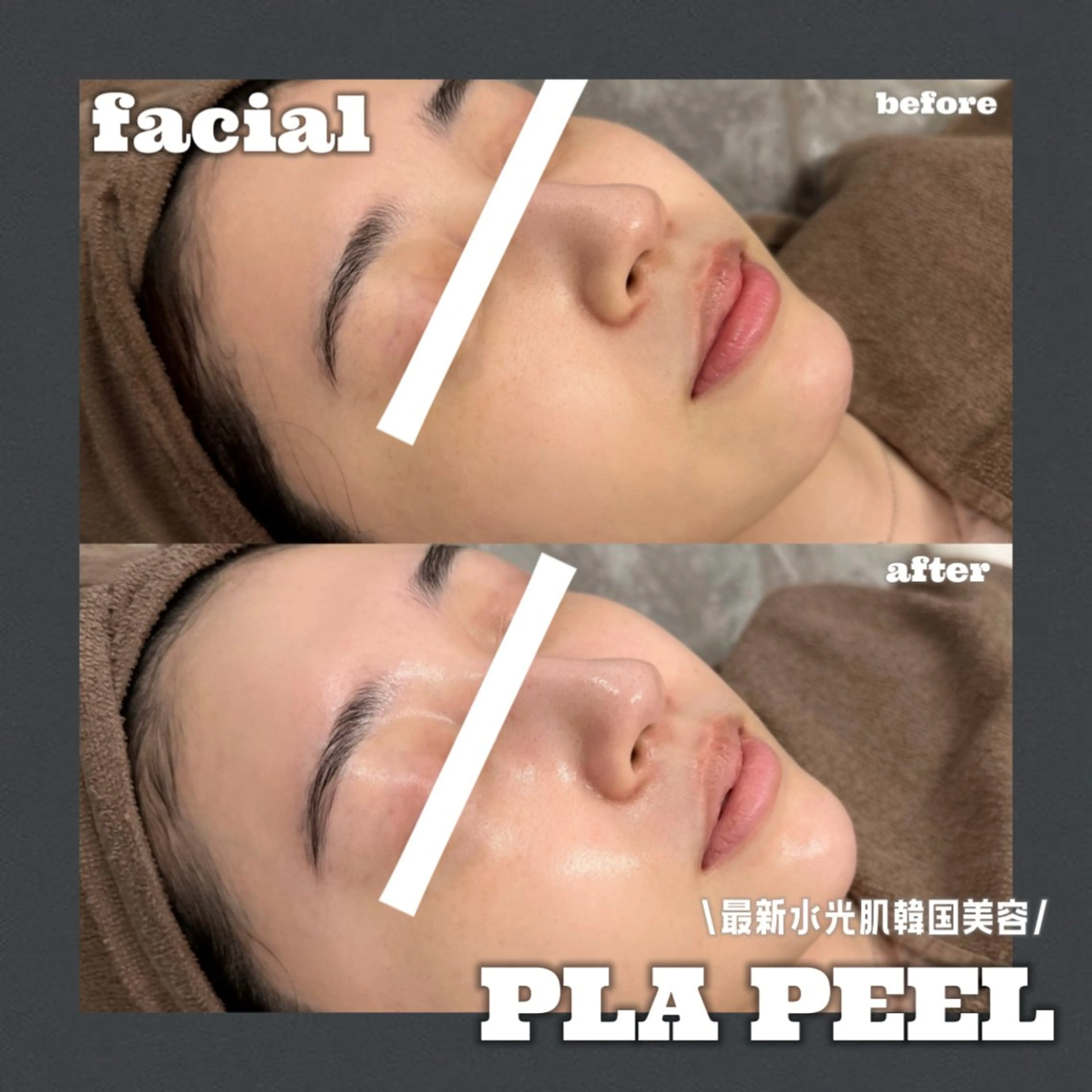 【⭐️話題のプラスキンピーリング⭐️】➕美白➕高保湿💎✨️今より更にツヤ肌へ✨️韓国美容業界大注目🇰🇷の写真