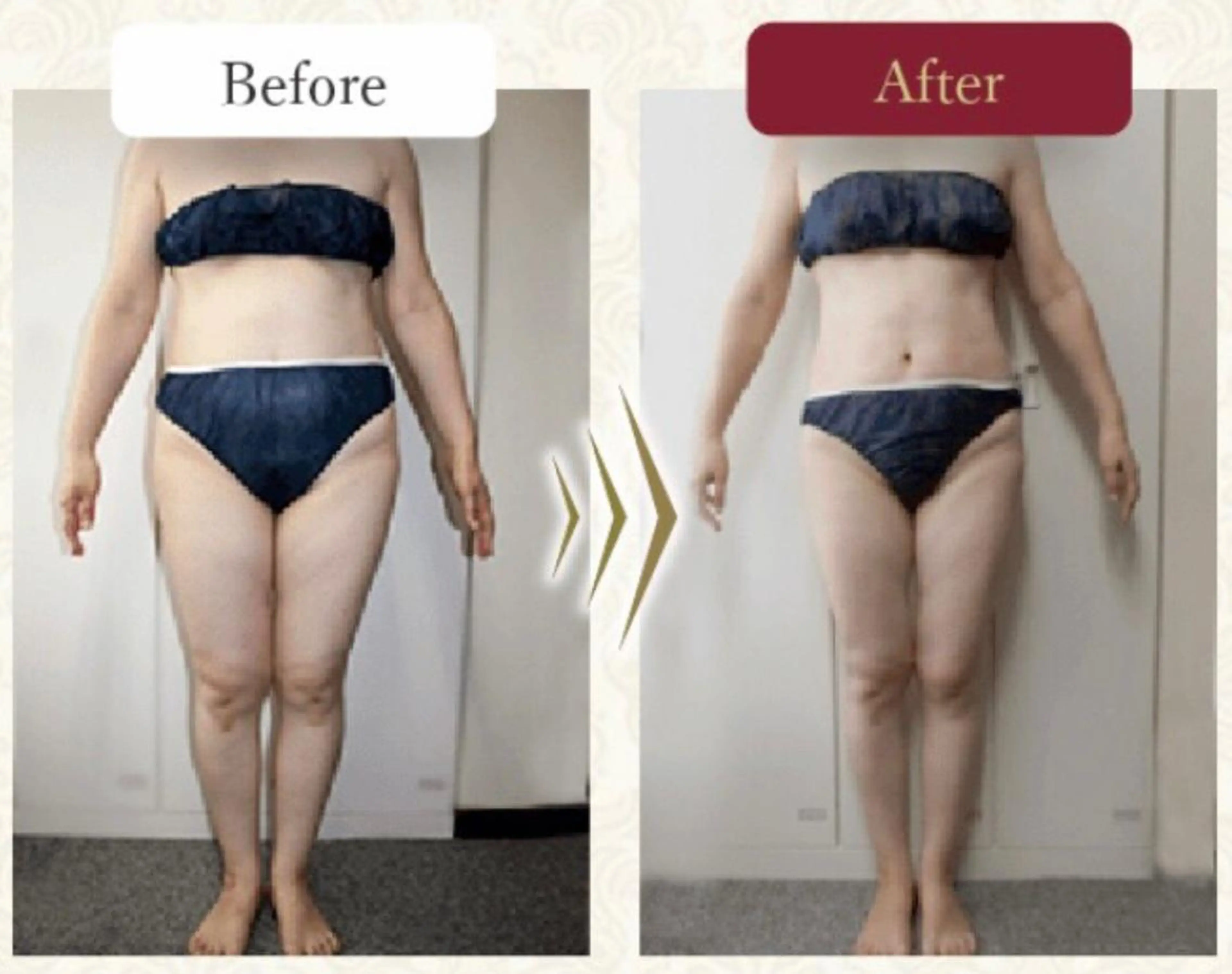 温活beautyサロンNeroli所属・切らない脂肪吸引🔥 Neroliまりこのエステ・リラクイメージ