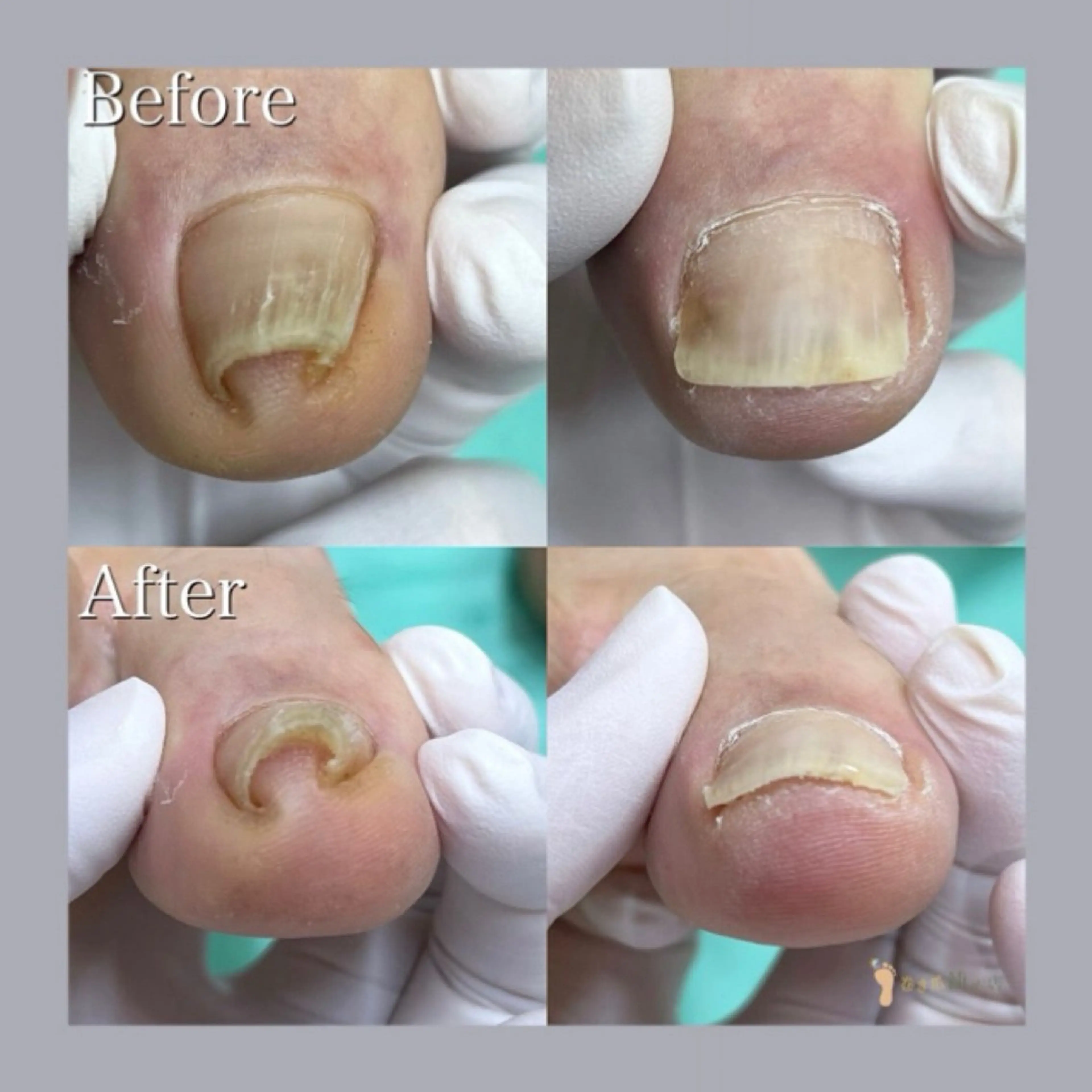 ミニモ限定価格‼️【巻き爪補正1ヶ所】痛い巻き爪は早めのケアが大切🚨形が気になる方もご相談ください!の写真