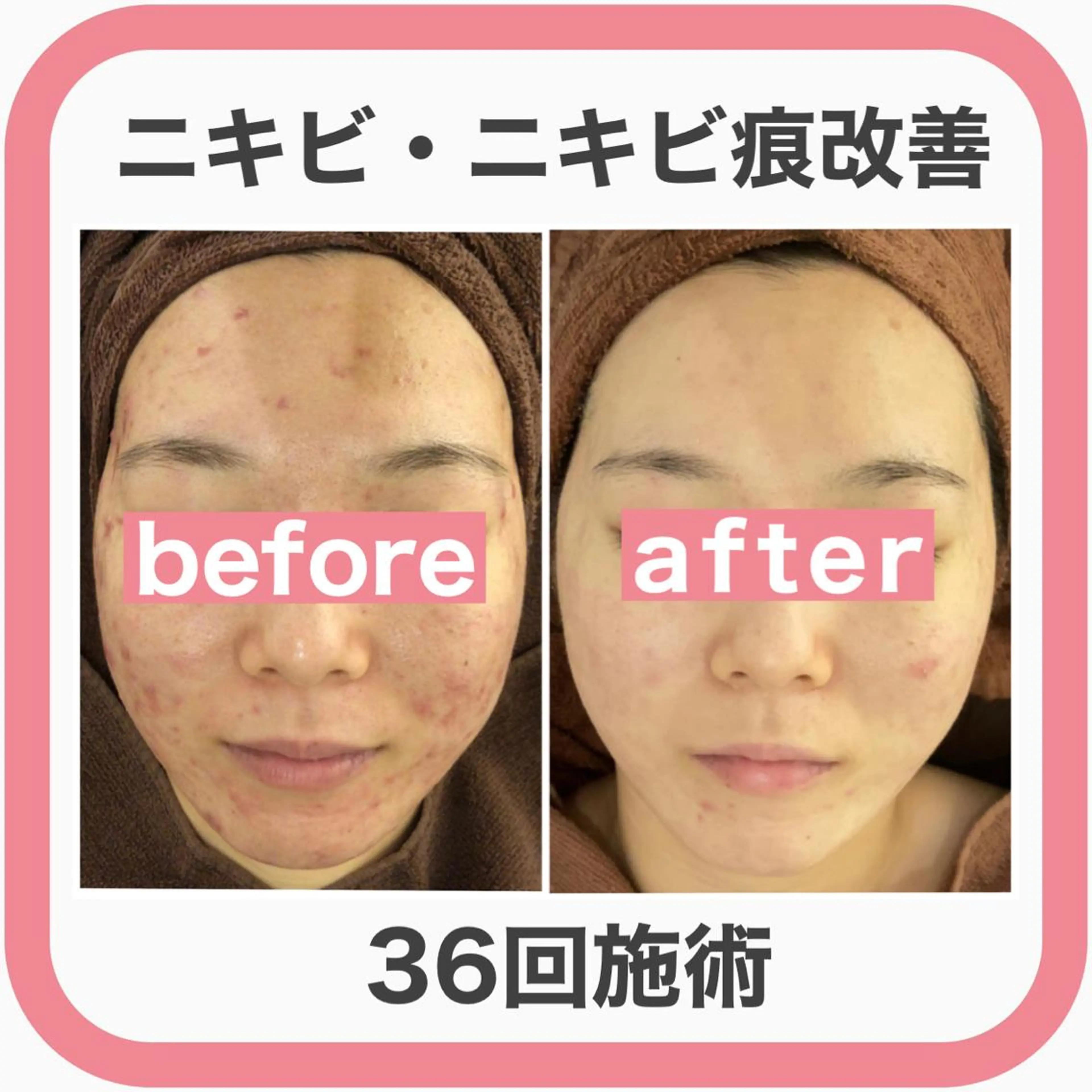 ミディアム カラー パーマ ヘアアレンジ メンズ キッズ ネイル マツエク・マツパ エステ リラク ニキビ・肌質改善専門 ♡人生が変わるサロンのエステ・リラクイメージ