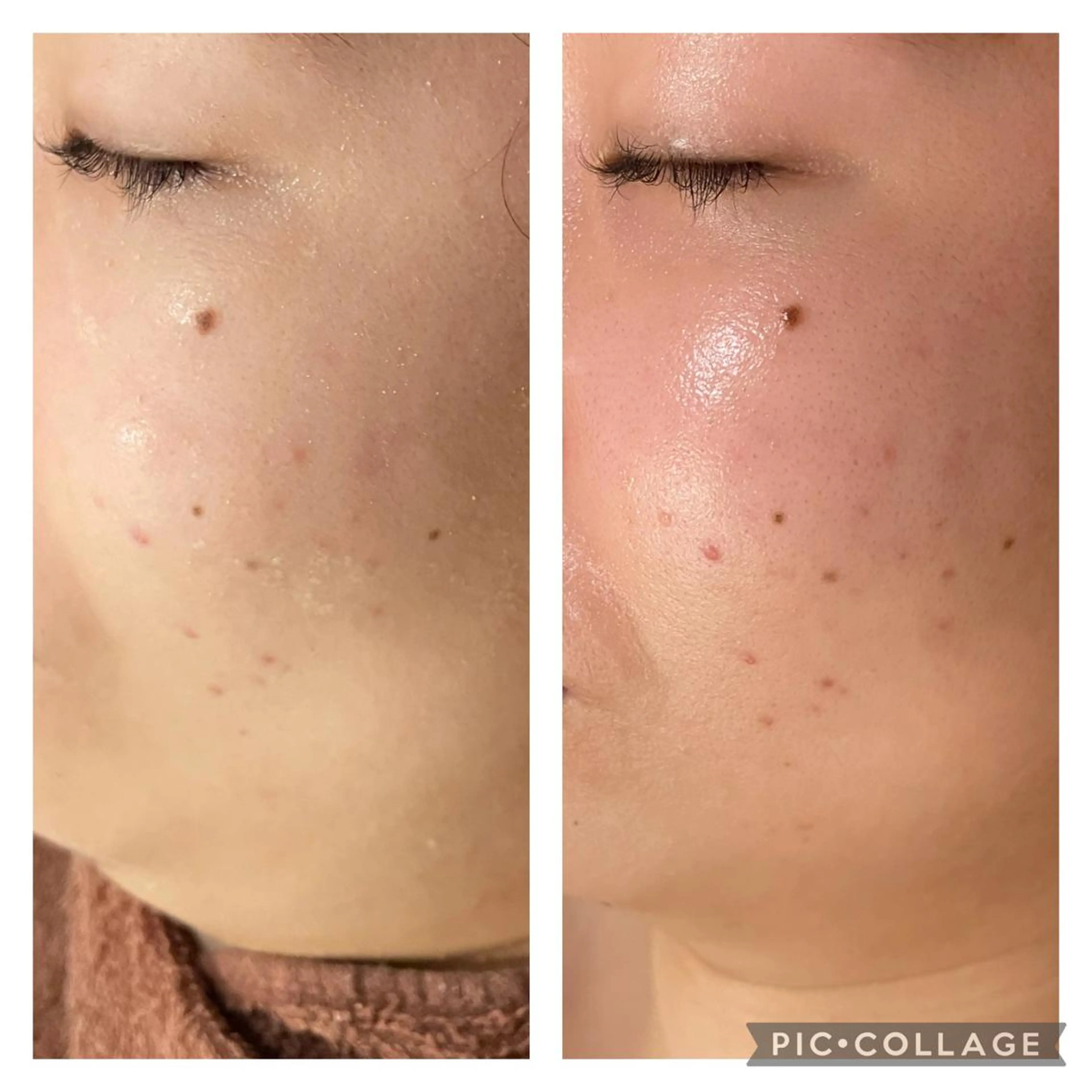 ミディアム カラー パーマ ヘアアレンジ メンズ キッズ ネイル マツエク・マツパ アイブロウ エステ リラク ニキビ特化型エステ 🍓最短で肌質改善のエステ・リラクイメージ