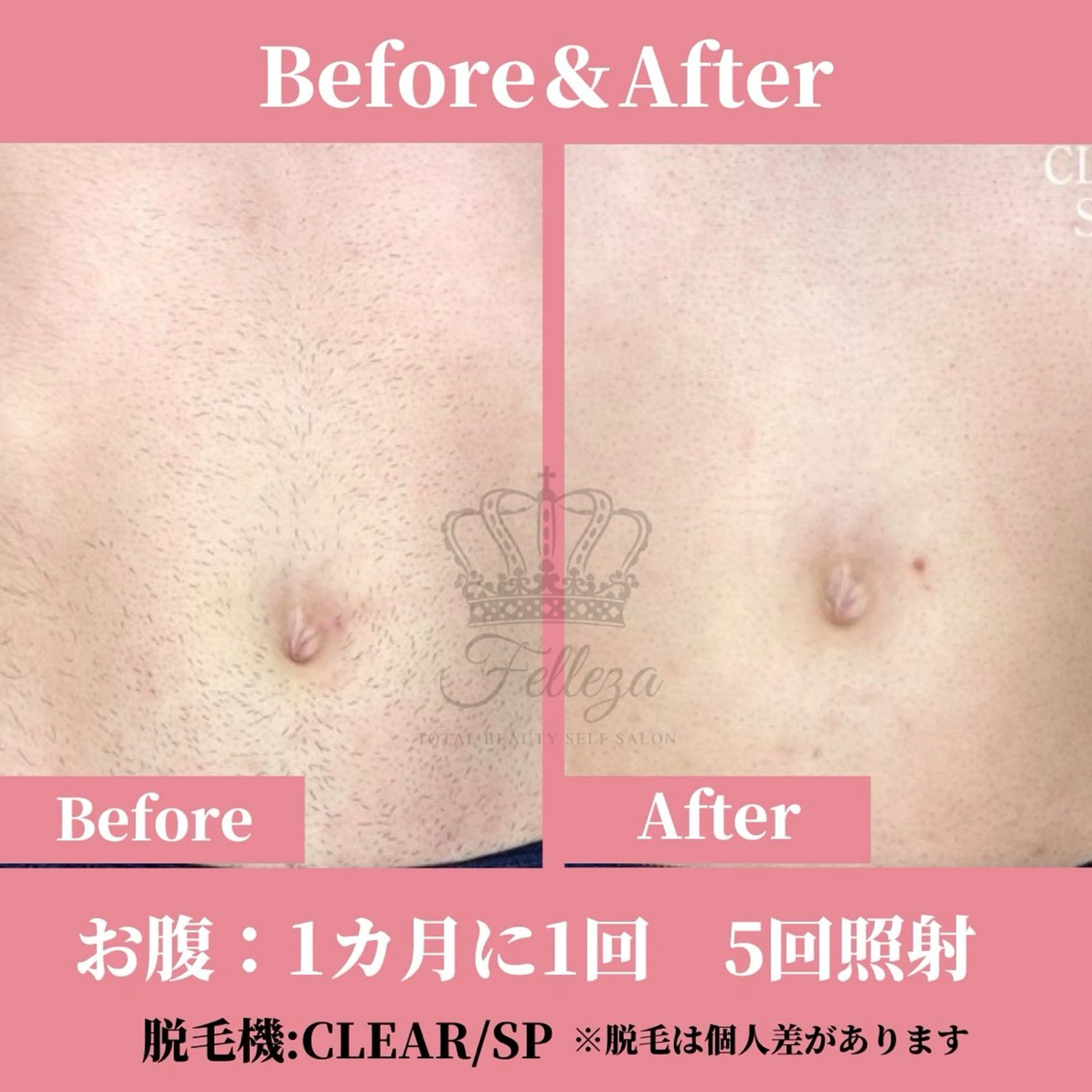 メンズ キッズ 有人型セルフサロン 脱毛/痩身/美顔のその他イメージ