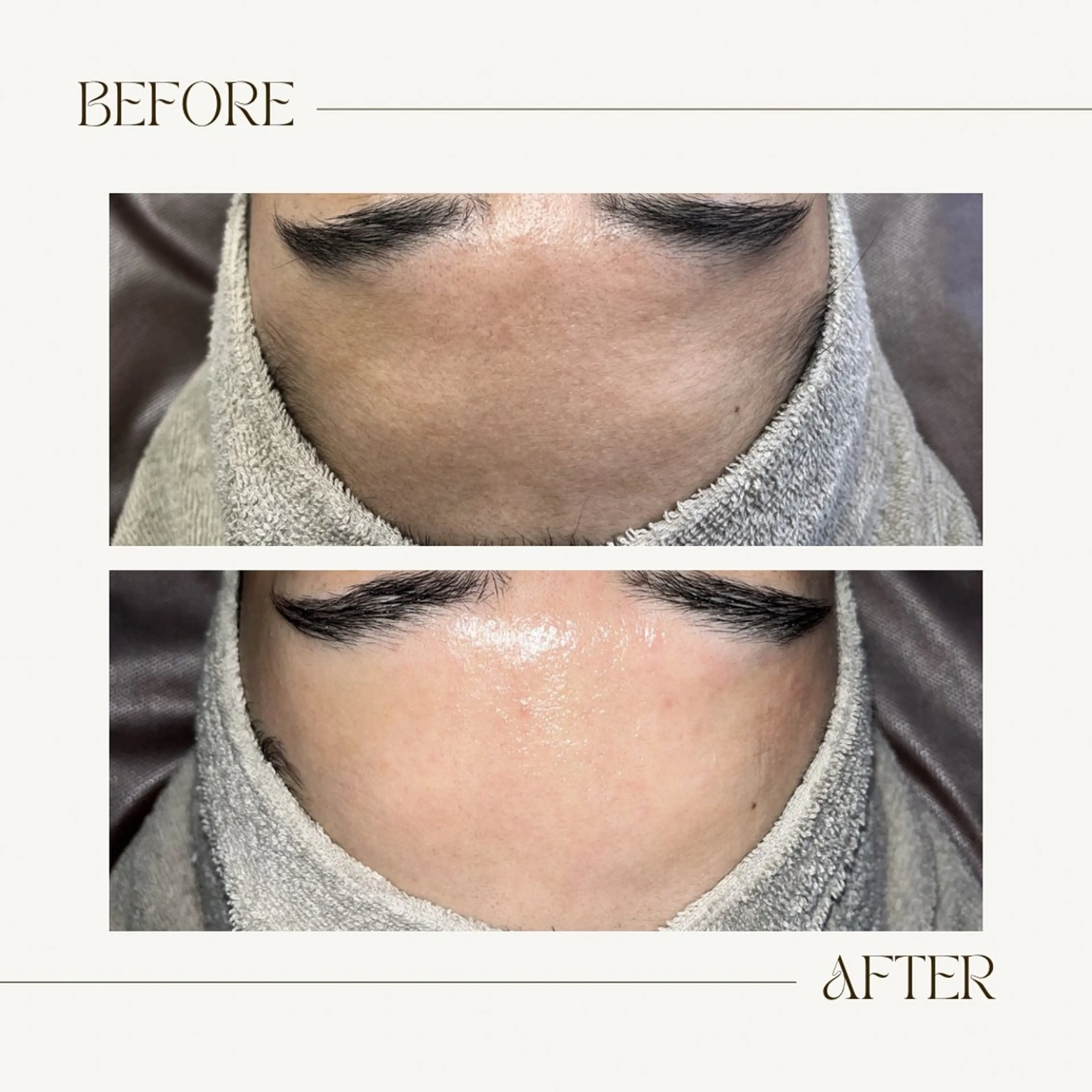 脱毛 1st｜フェイシャル エステ専門店のエステ・リラクイメージ