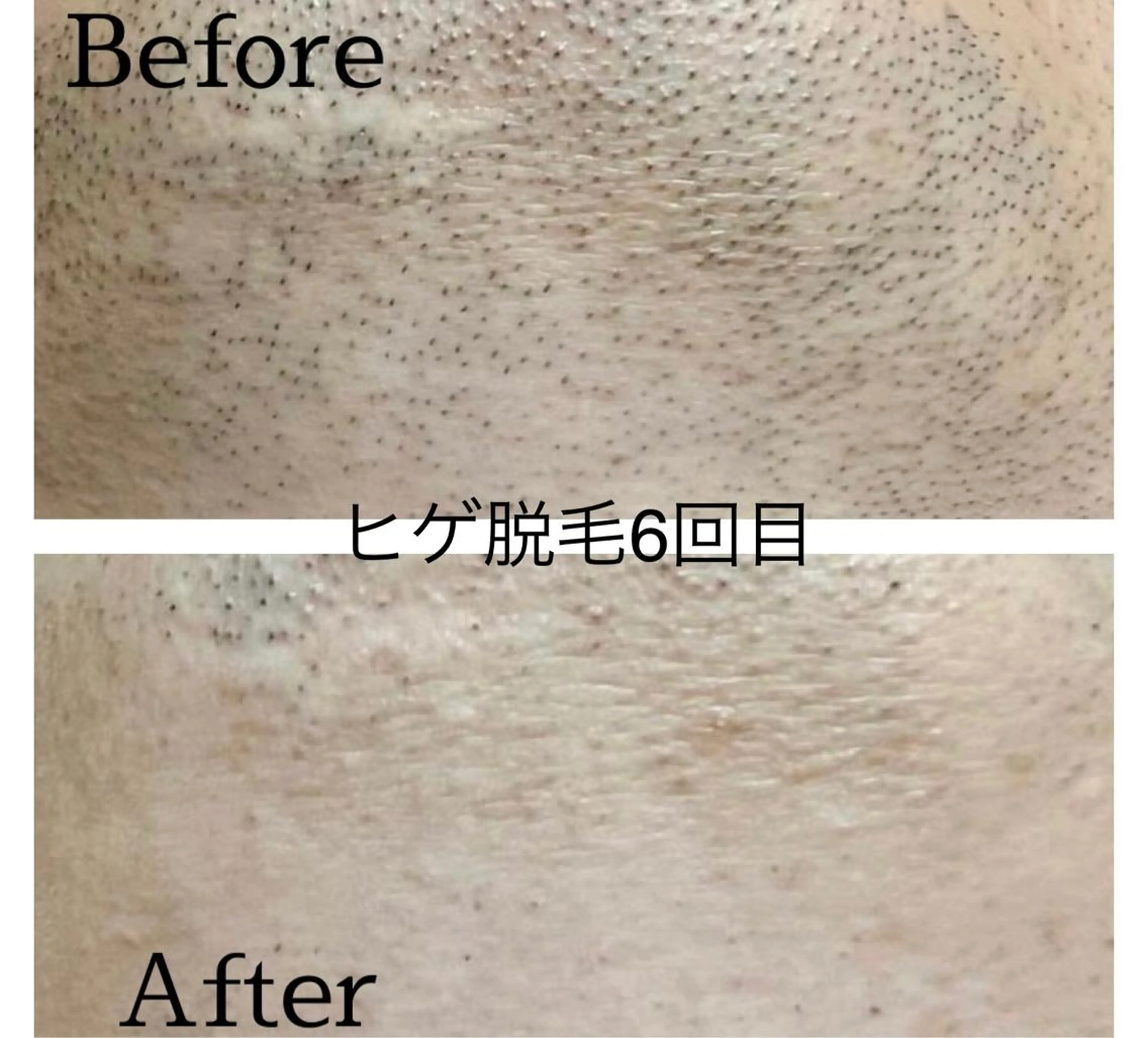 メンズ 学生（メンズ向け） 医療提携メンズ脱毛 CDFAkasakaのエステ・リラクイメージ