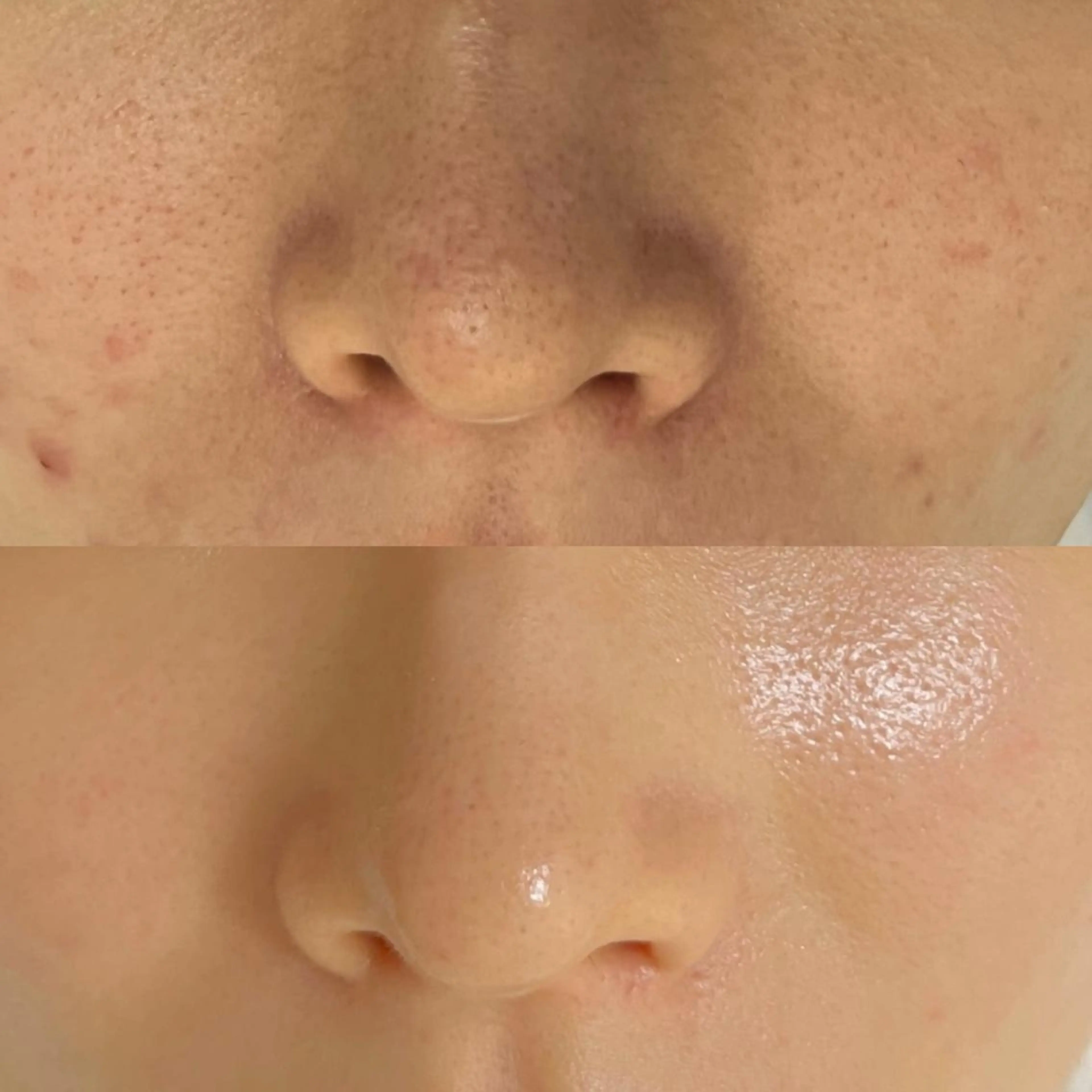 口コミ限定❕【ララピールの進化版！セラピール！】毛穴＆ニキビに最強！韓国女優肌が叶う🎵(所要時間70分)の写真