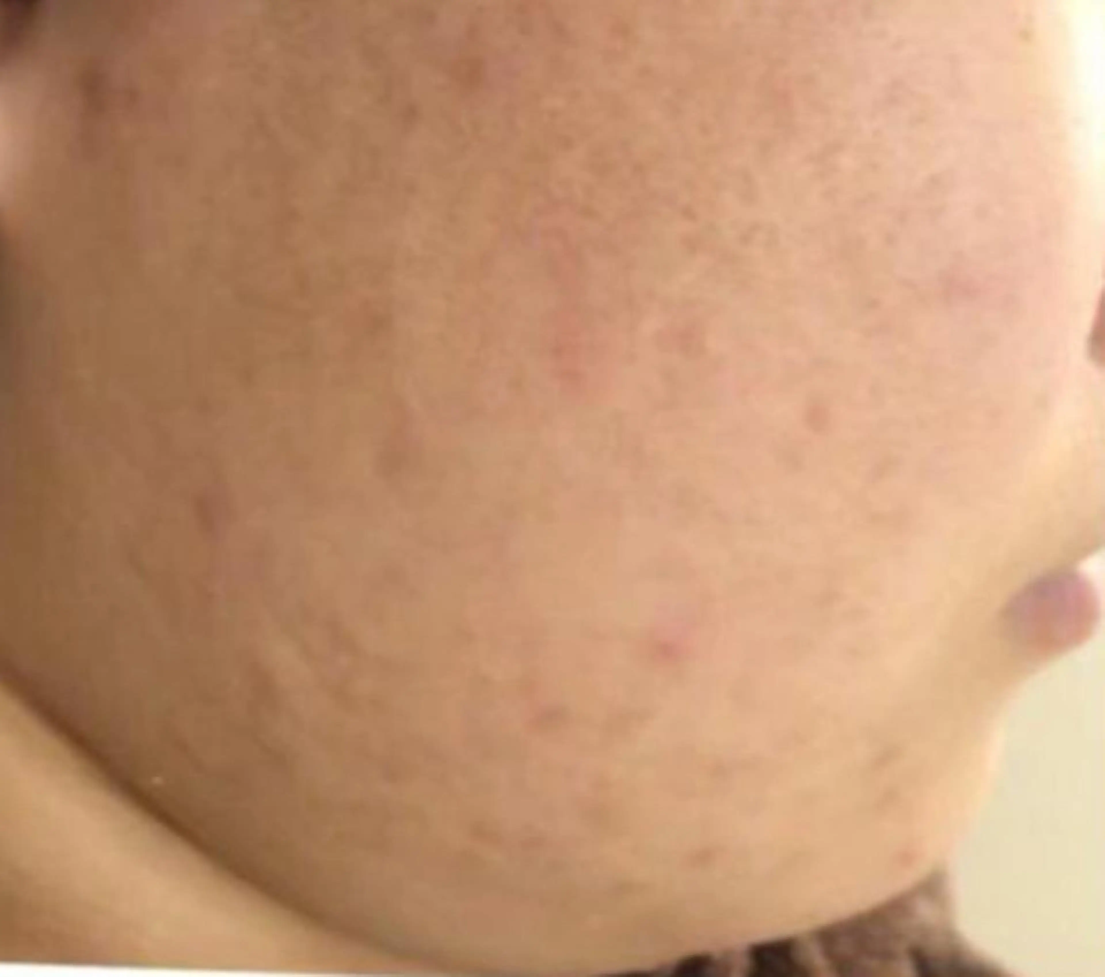 夏までに肌荒れ卒業 するサロン🌻のエステ・リラクイメージ