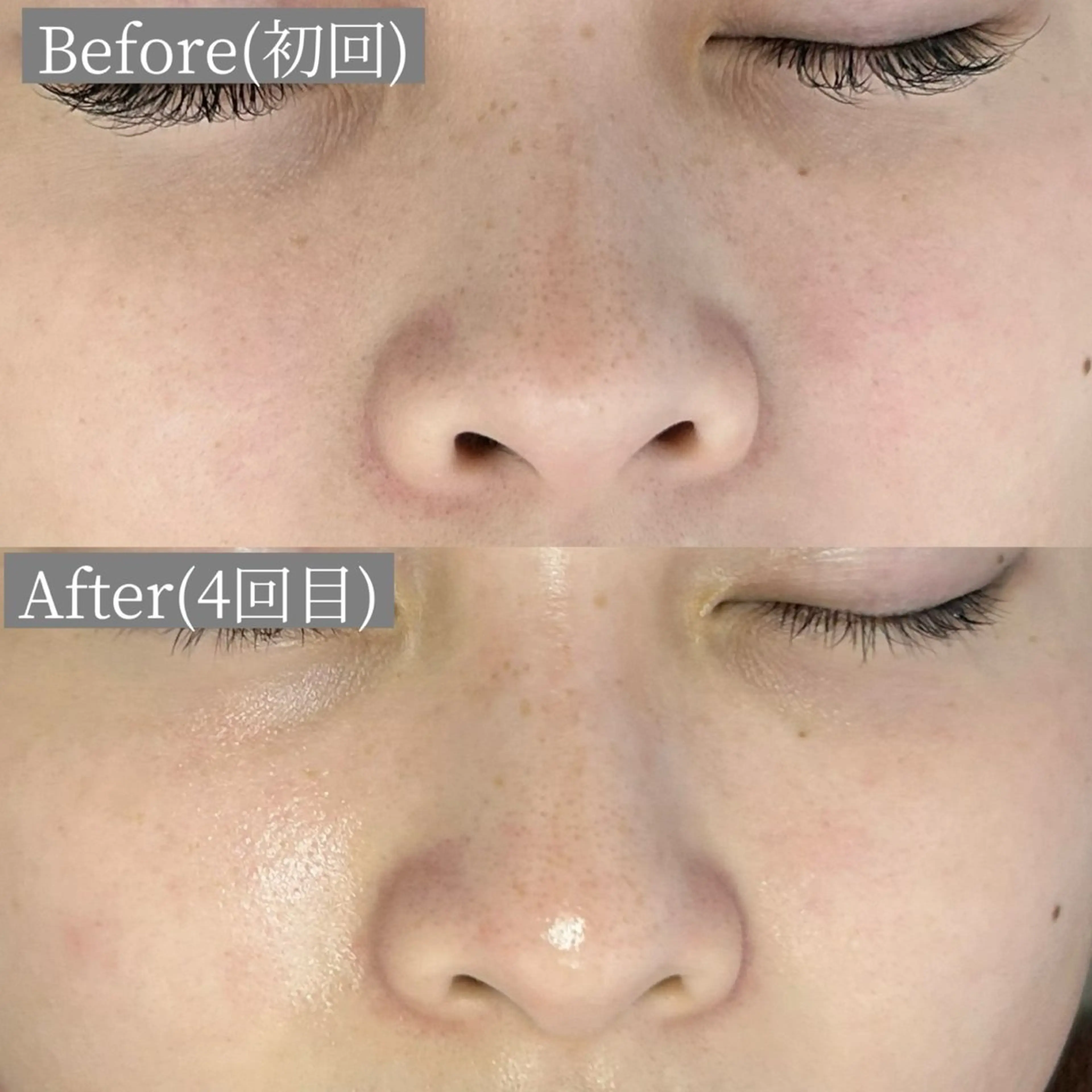 エステ リラク 毛穴・ニキビケア　ハーブピーリング【肌管理専門店】WHITE AQUA鳳店所属・ホワイトアクア 鳳店のエステ・リラクイメージ