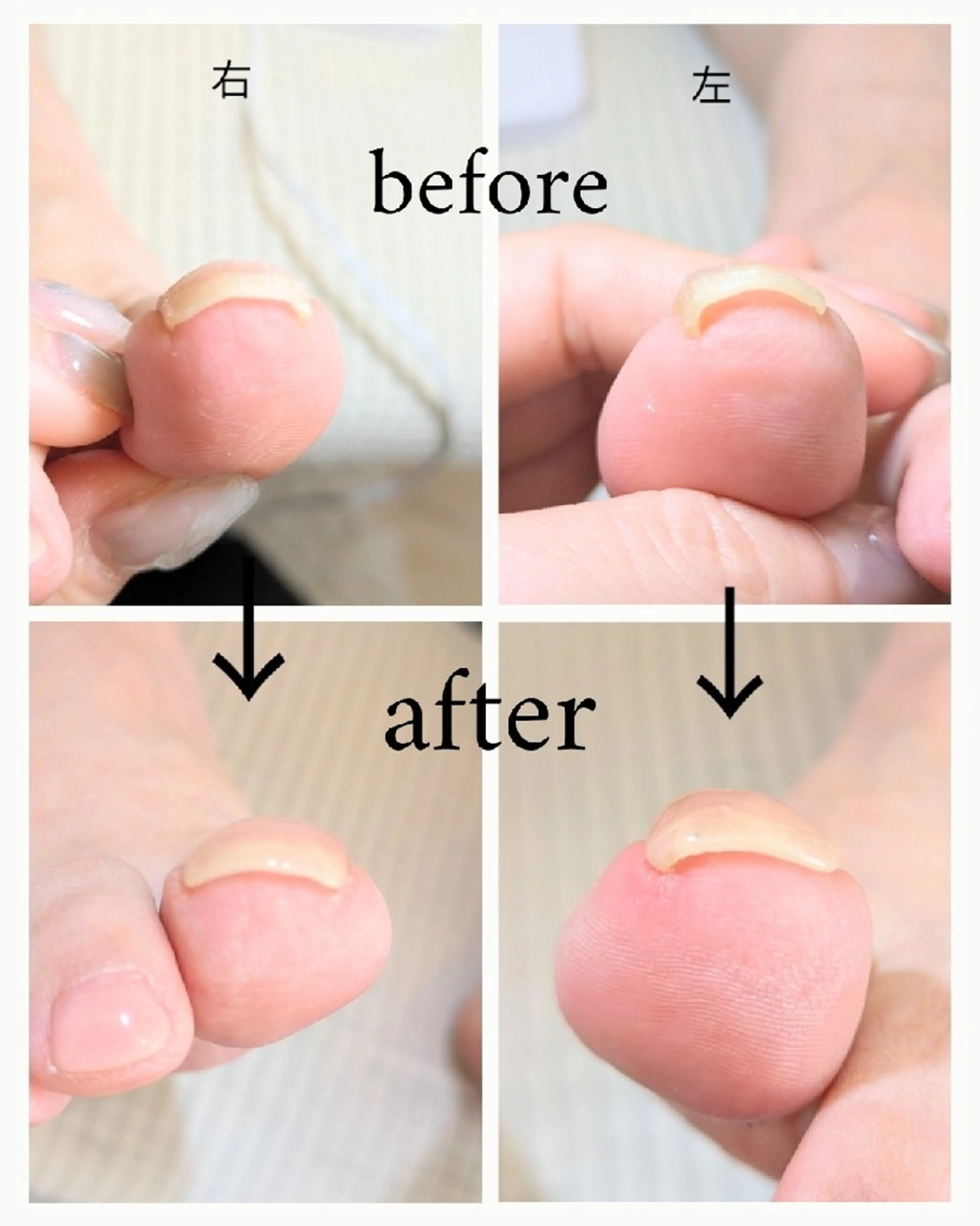 【フット】巻き爪が広がる！特殊ジェル(クリア)の写真