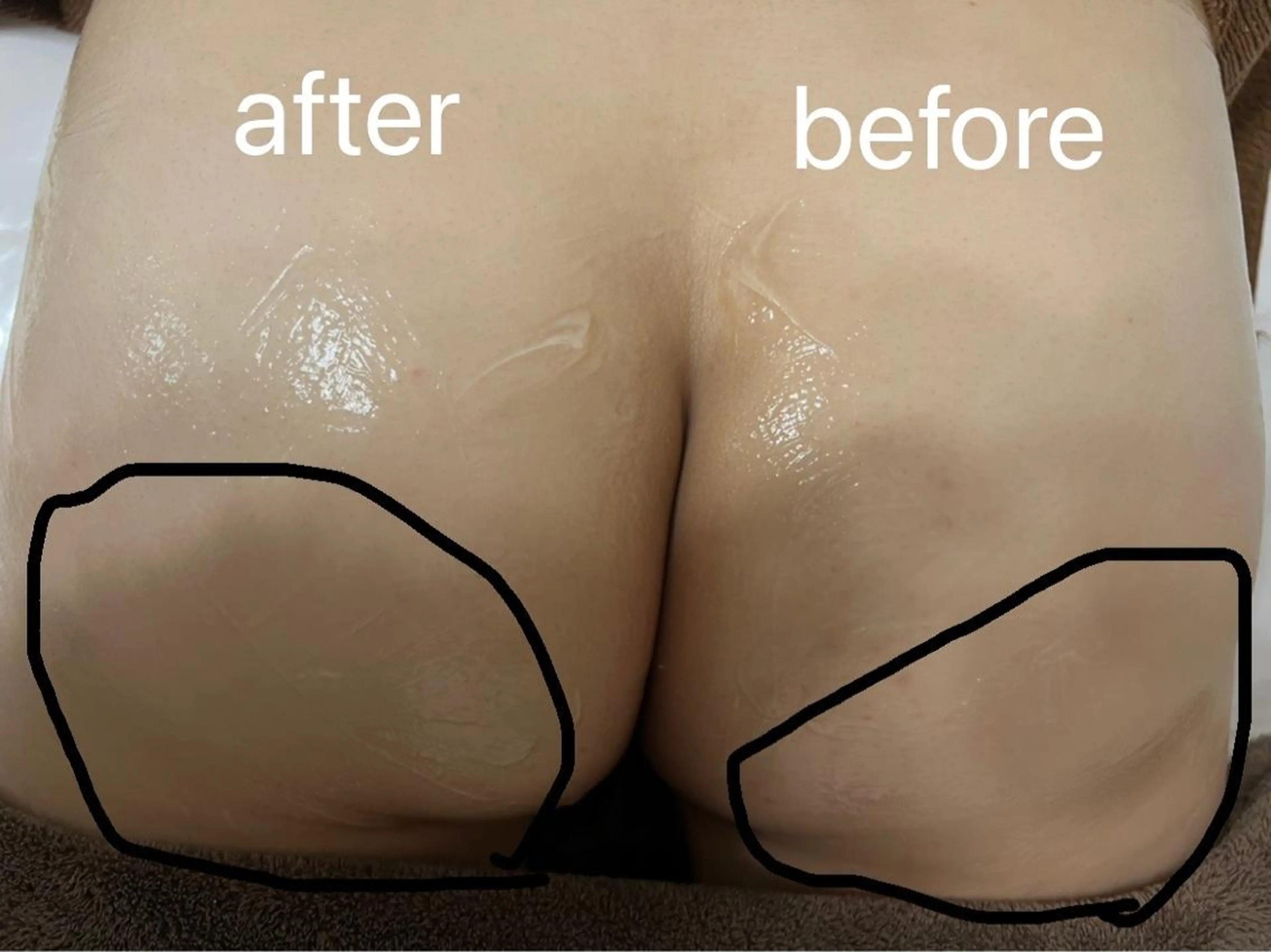 【ヒップアップ&黒ずみ・ざらつき・色素沈着・ニキビ/光ヒップ】究極の美尻ケア🍑の写真