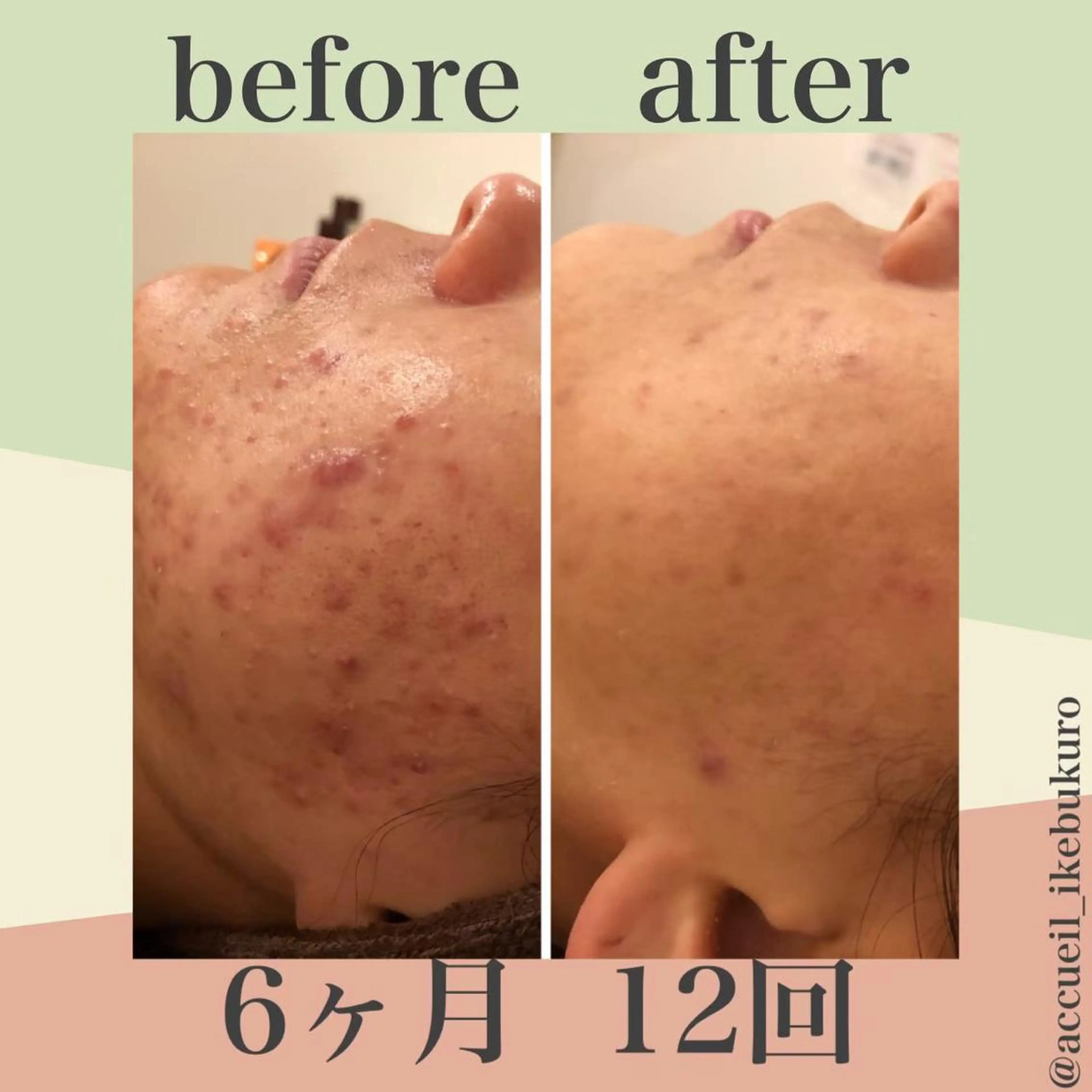 ミディアム カラー パーマ ヘアアレンジ メンズ キッズ ネイル マツエク・マツパ エステ リラク ニキビ・肌質改善専門 ♡人生が変わるサロンのエステ・リラクイメージ