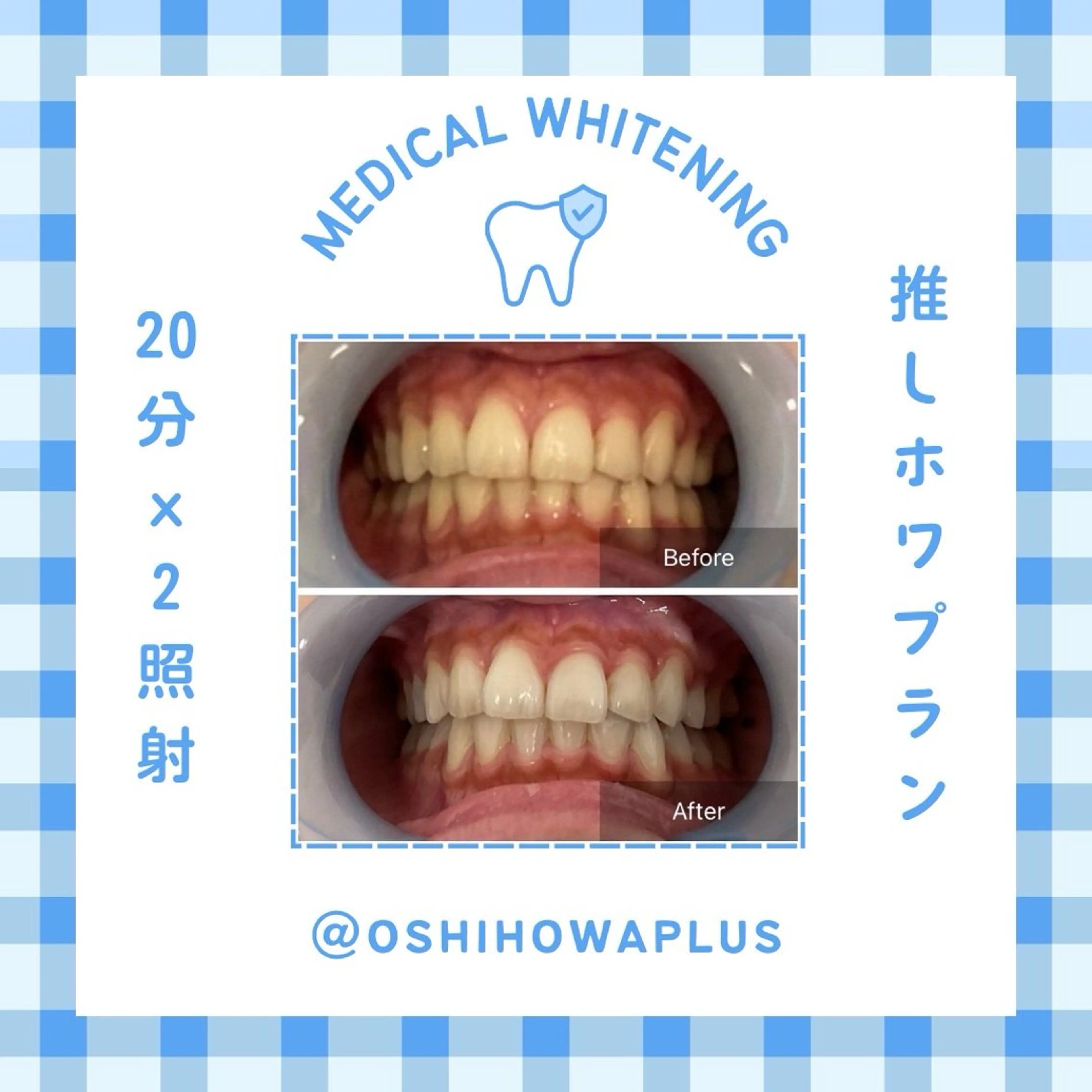 オフィスホワイトニング 回数券 7日分(20分×2回照射 14回)の写真