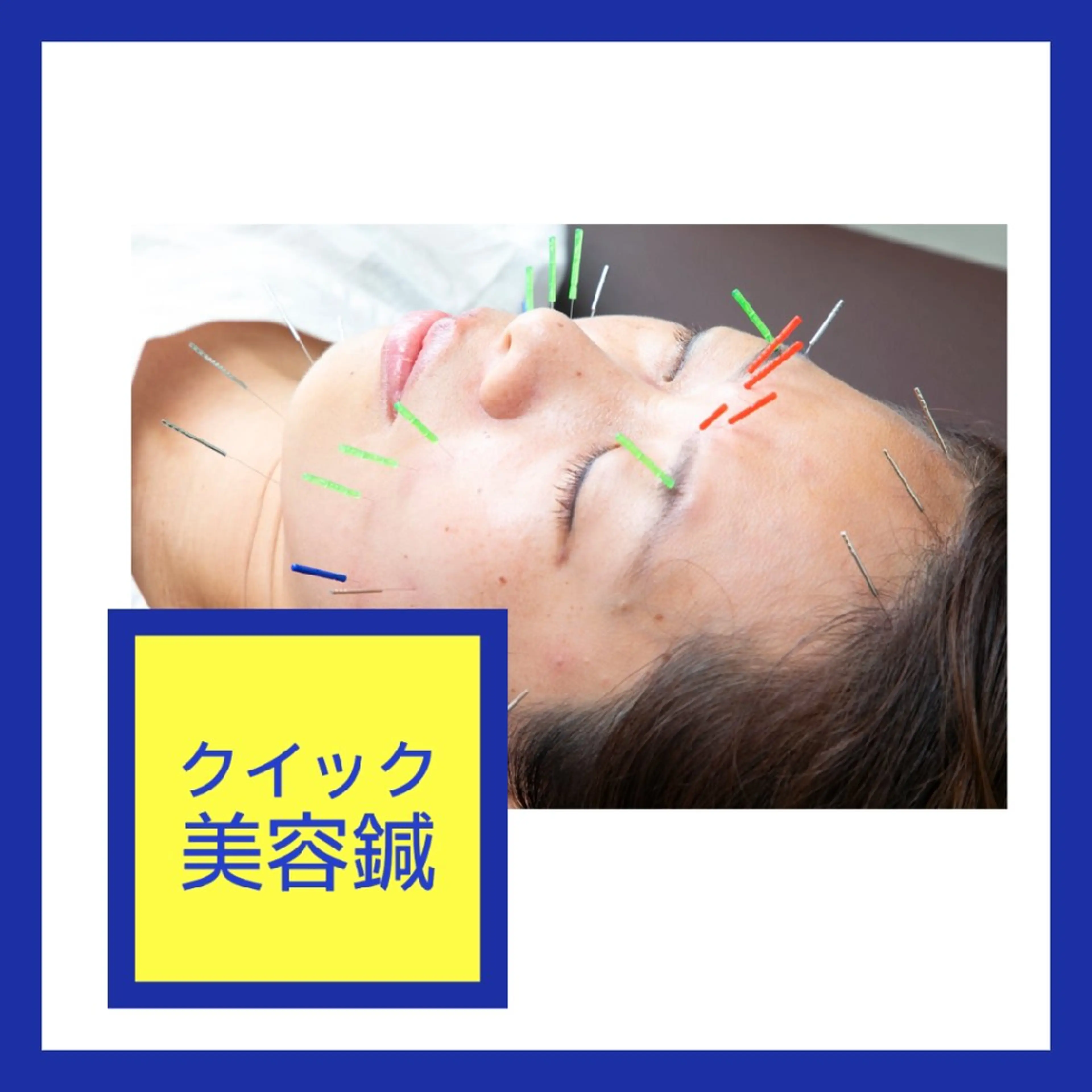 パッと受けてお顔シュッと【クイック電気美容鍼】初回お試し/鍼はじめてさん向け/むくみでパンパンの顔すっきりの写真