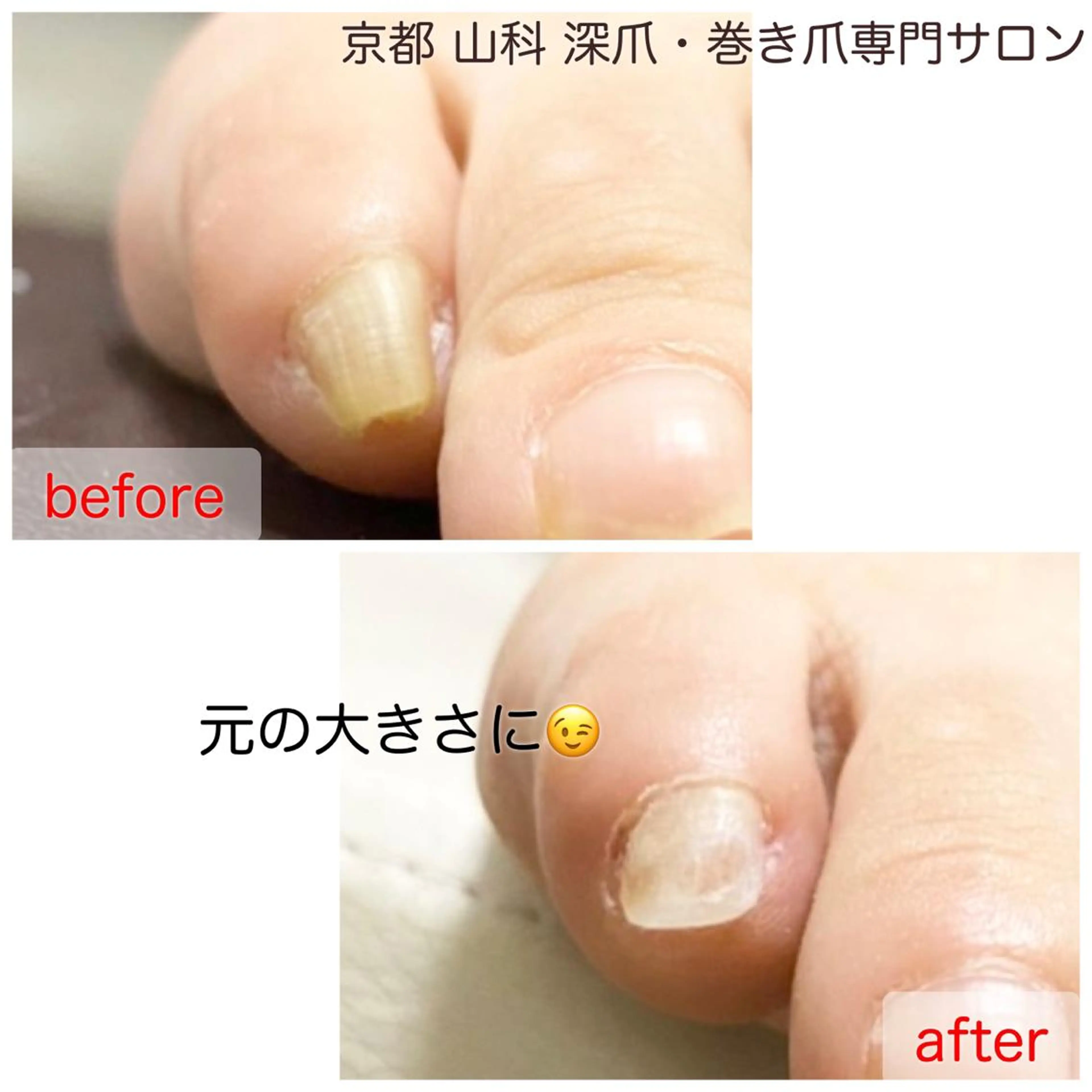 巻き爪補正(親指以外1本)の写真