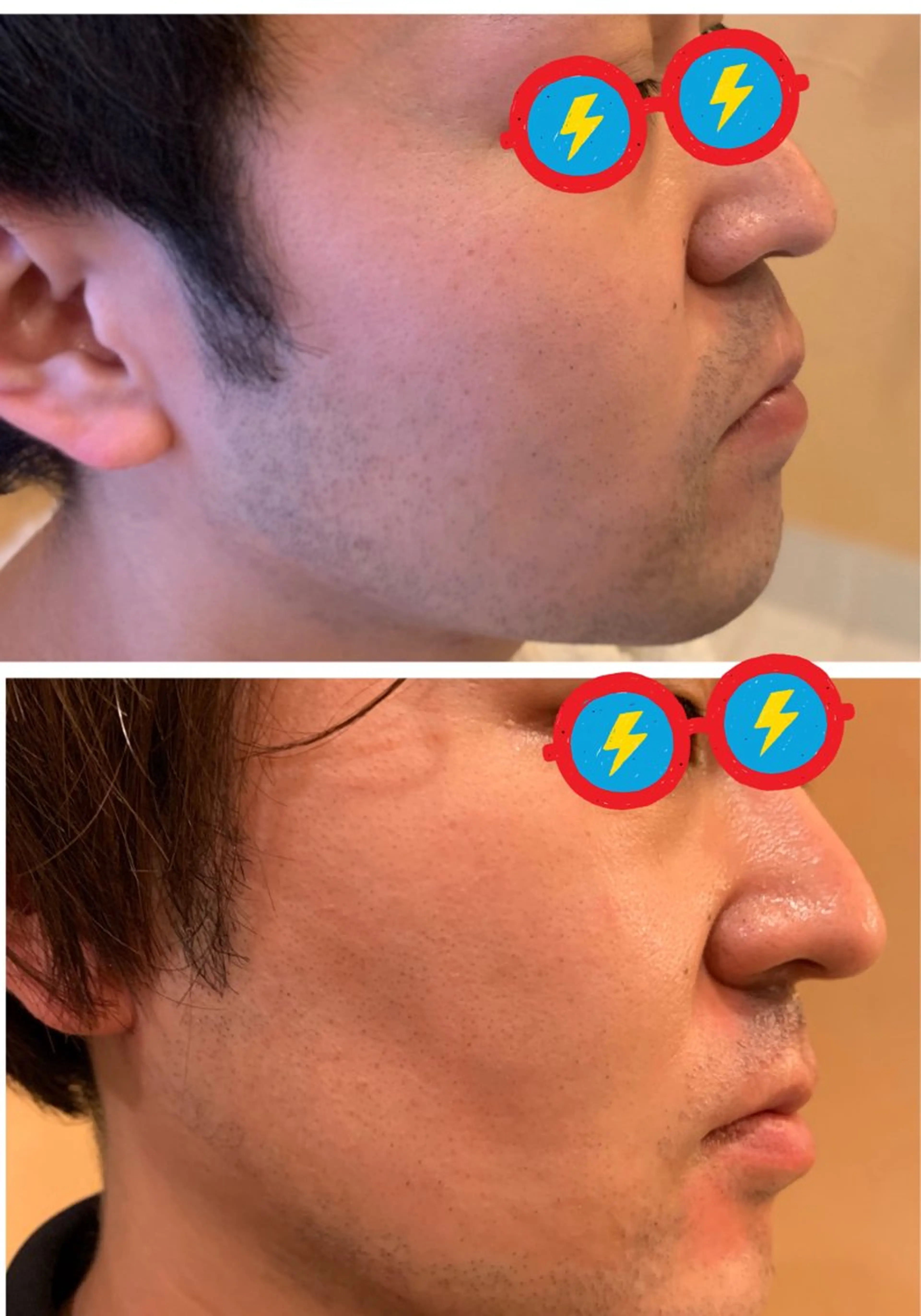 need(制毛器)体験の写真