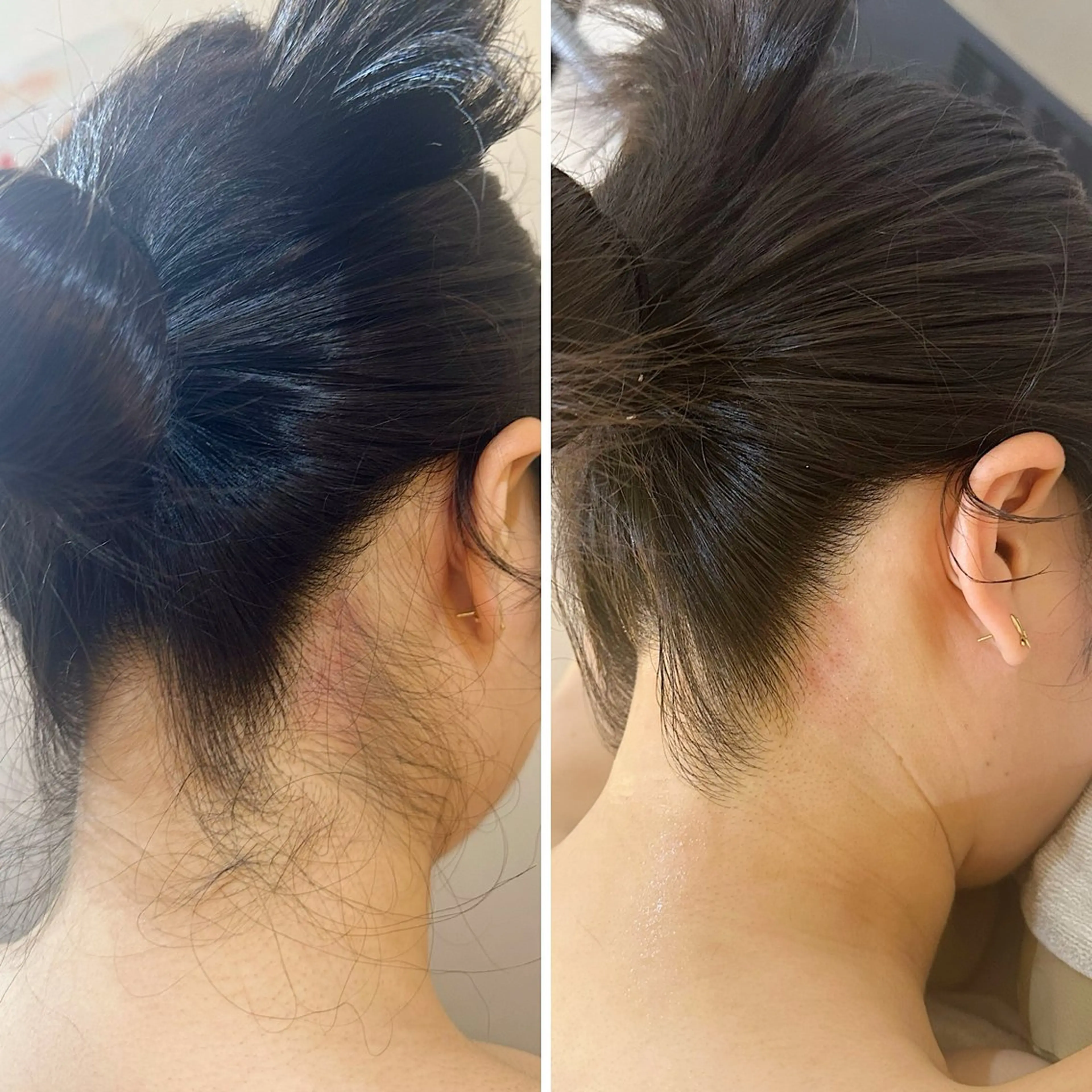 脱毛 うなじ脱毛/美肌脱毛 LABELのエステ・リラクイメージ