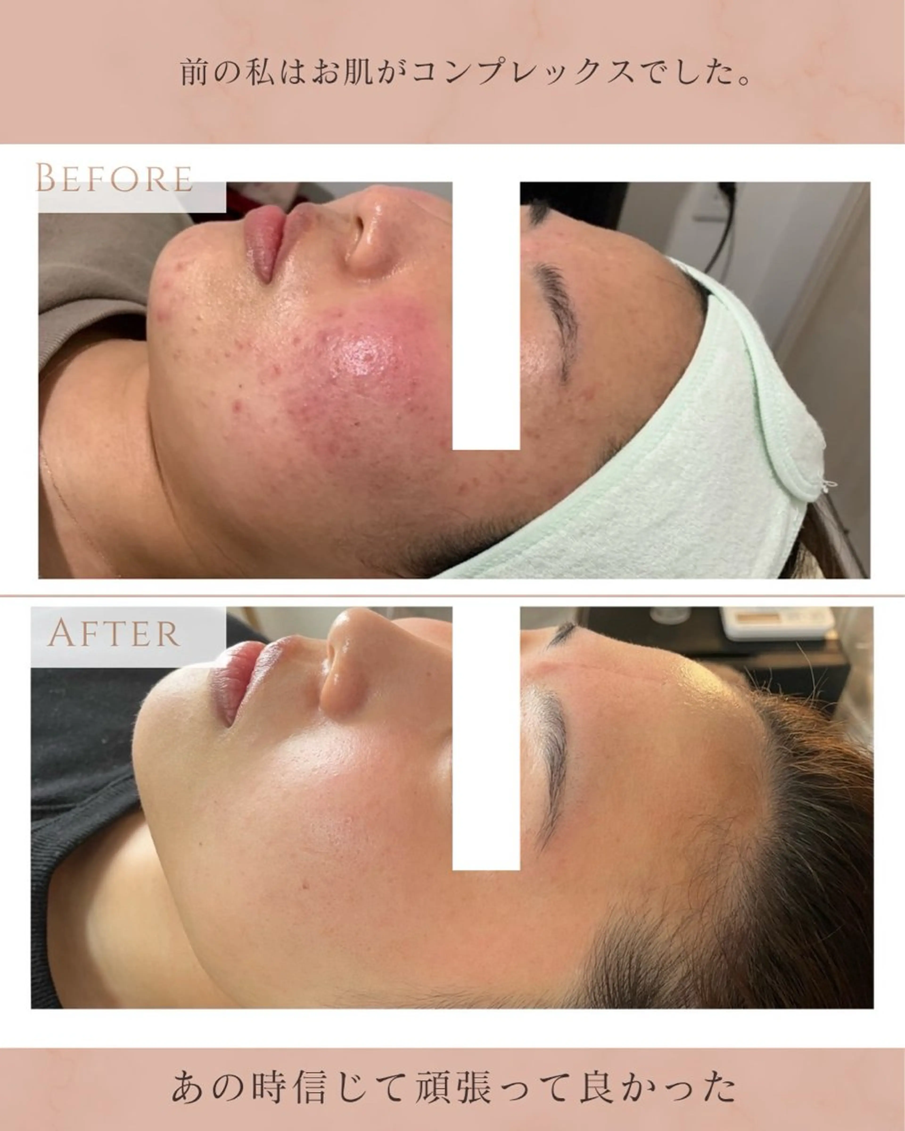 エステ NARIS BEAUTY STATION　デ・アイム あべのルシアス所属・ニキビ跡/毛穴/ 肌質改善/北村ももこのエステ・リラクイメージ