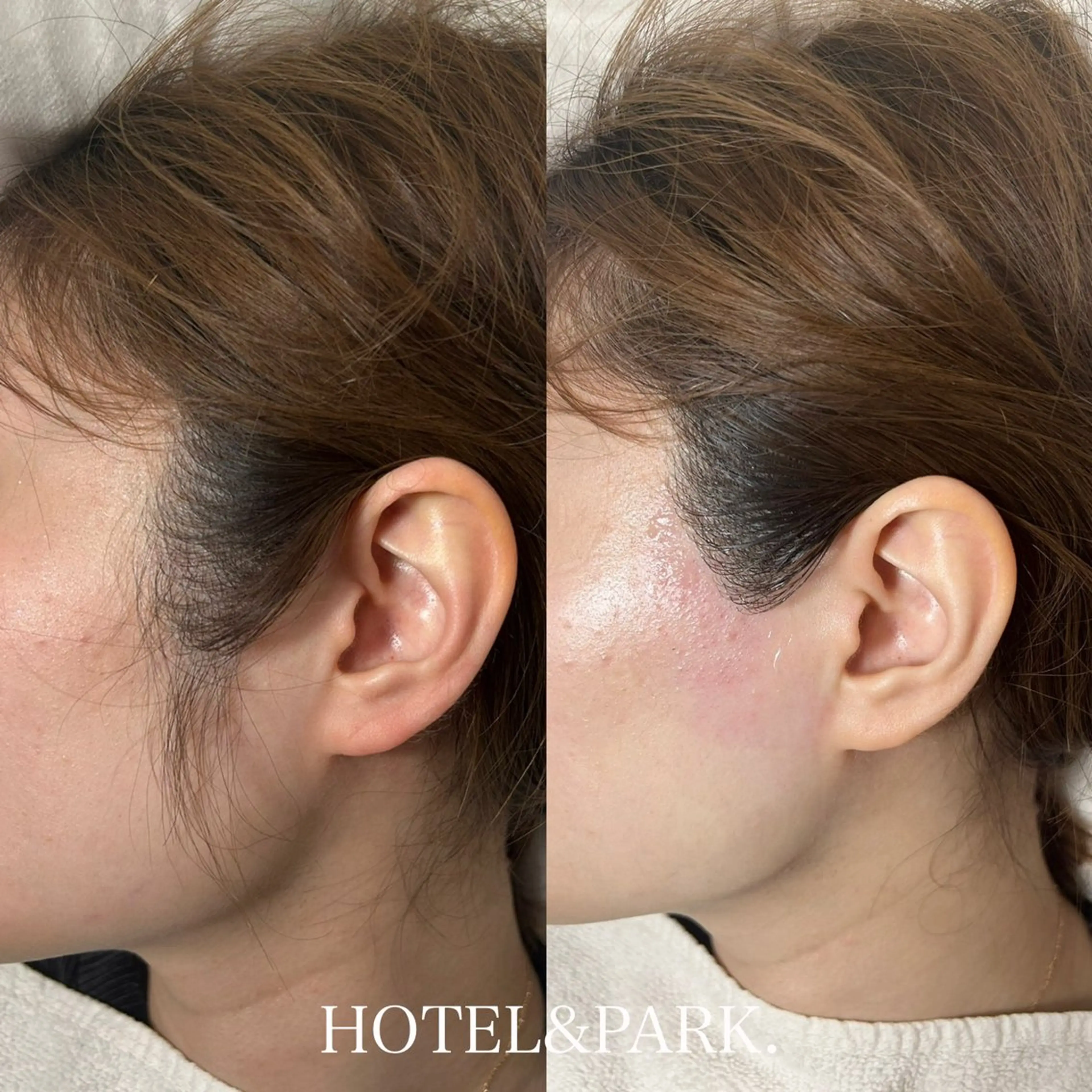 【もみあげワックス脱毛】の写真