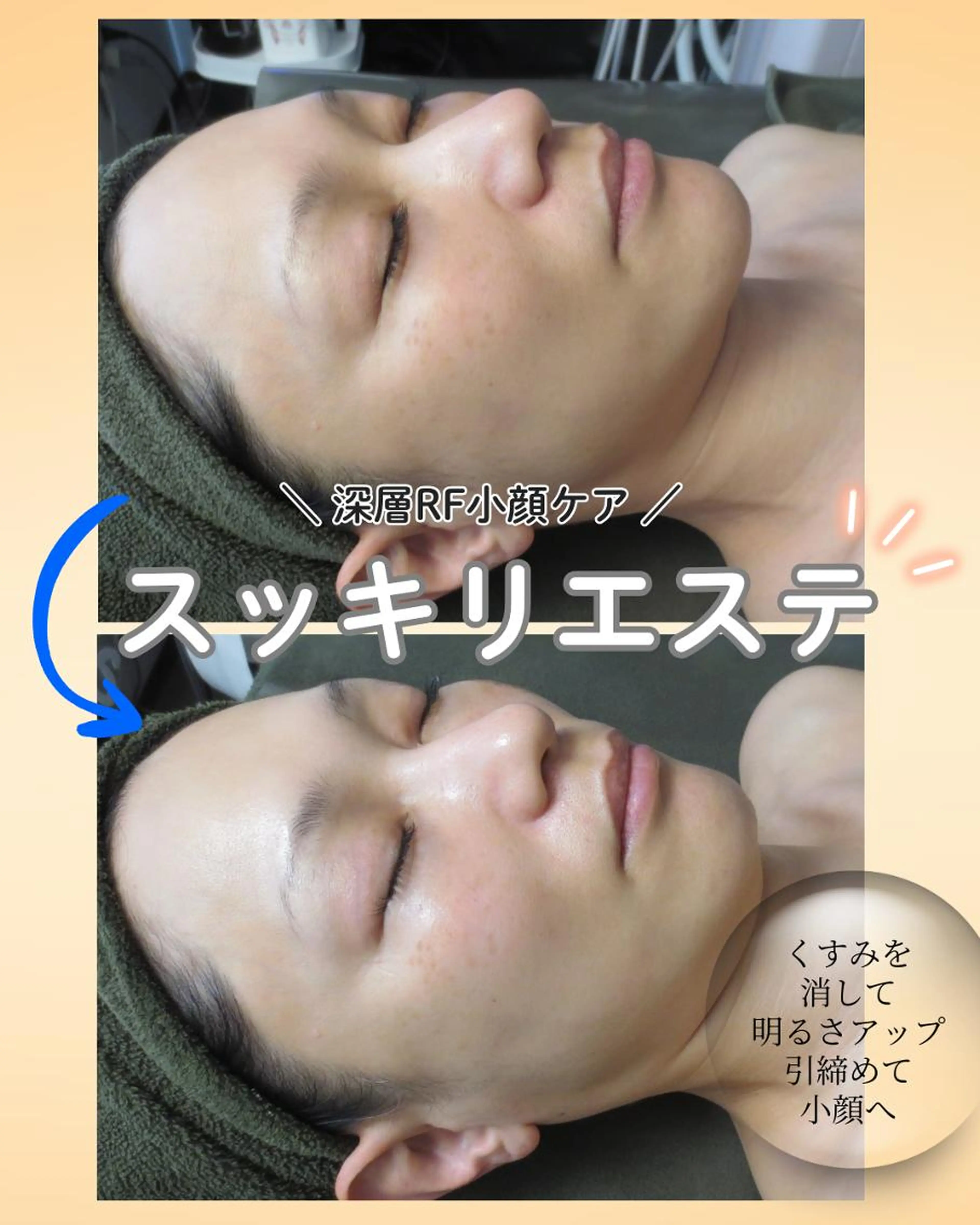 【小顔・引締め・スッキリしたい方】【期間限定】深層RF小顔ケア90分の写真