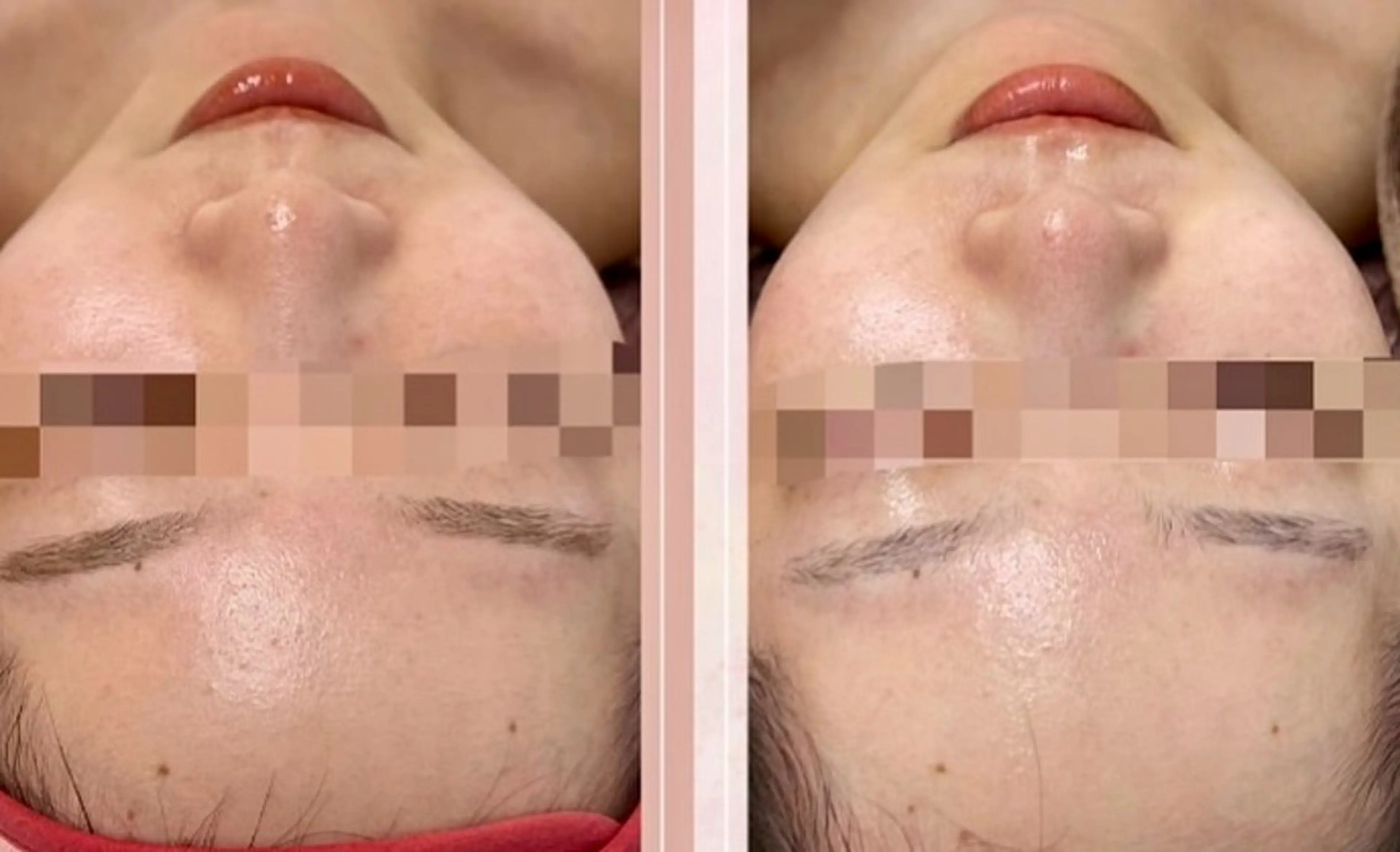 最新✨【韓国🇰🇷で大人気💆‍♀️最新第4世代ピーリング】ララピール🖌️💕DT一切なし✖×即効性💎◎の写真