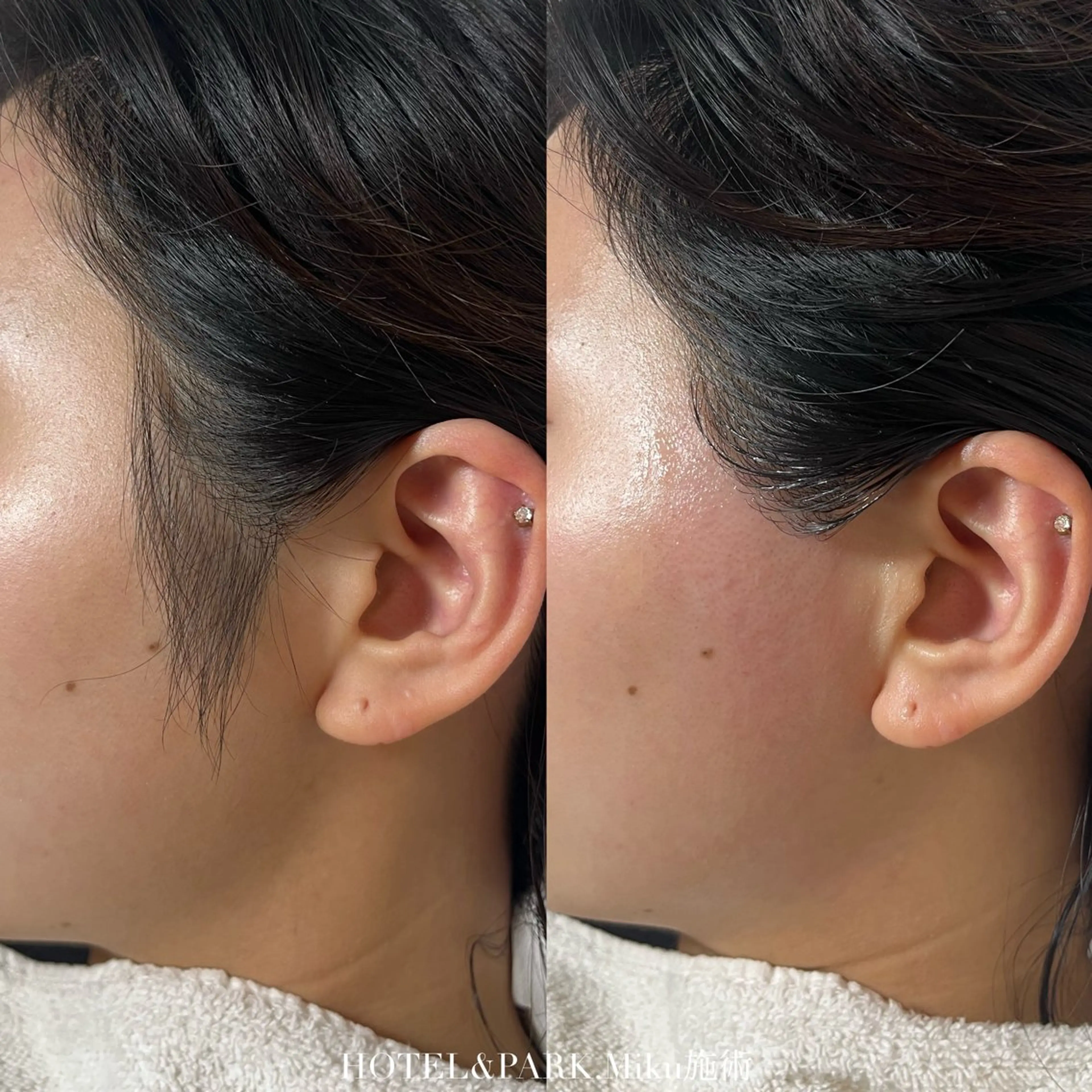 HOLIDAY SALE❄️☃️40%OFF❤️【VIO+もみあげブラジリアンワックス脱毛】の写真