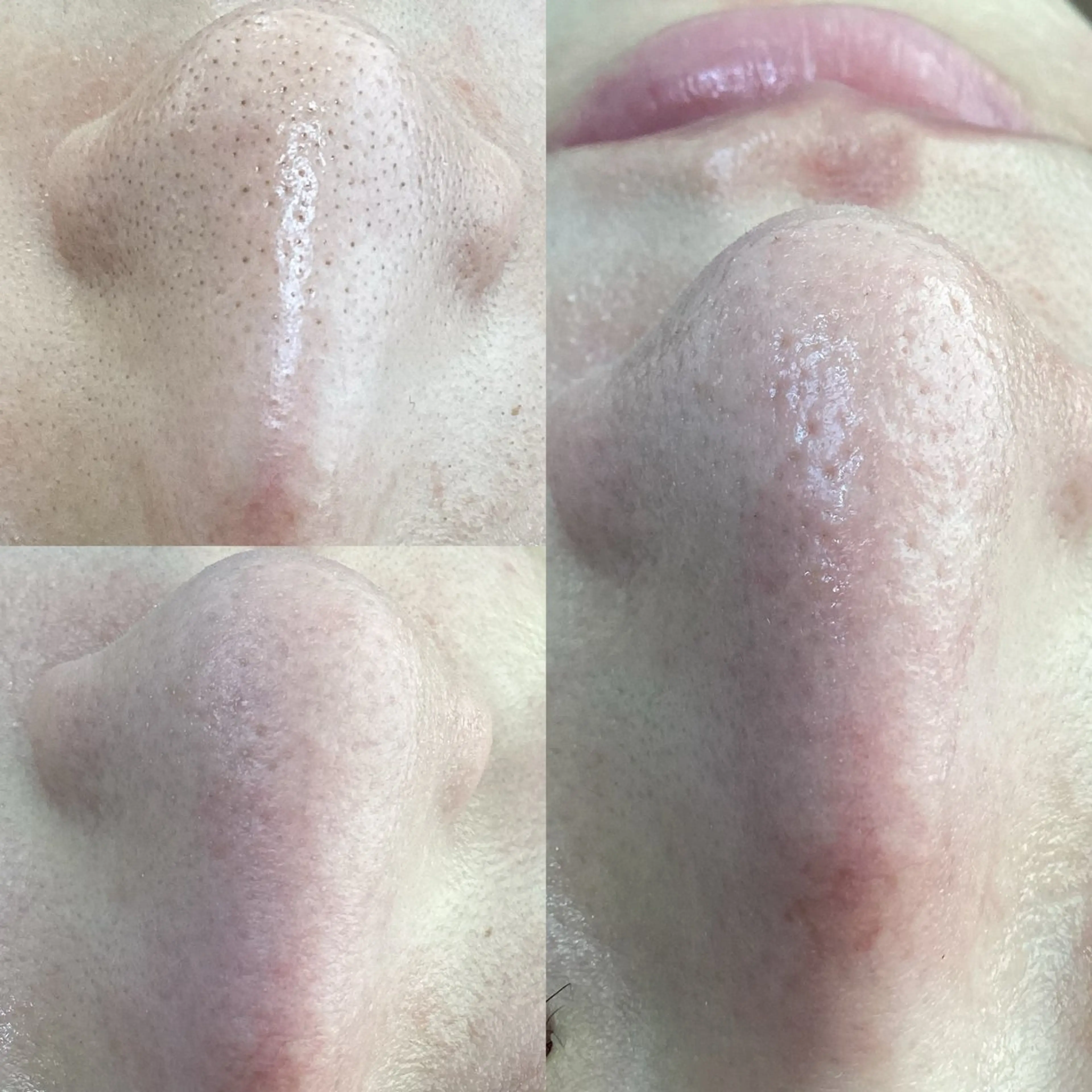 12/25限定モニター価格【毛穴洗浄】毛穴レスでSNSで話題沸騰中！韓国式3D毛穴洗浄！ブラックヘッド・いちご鼻解消‼︎の写真