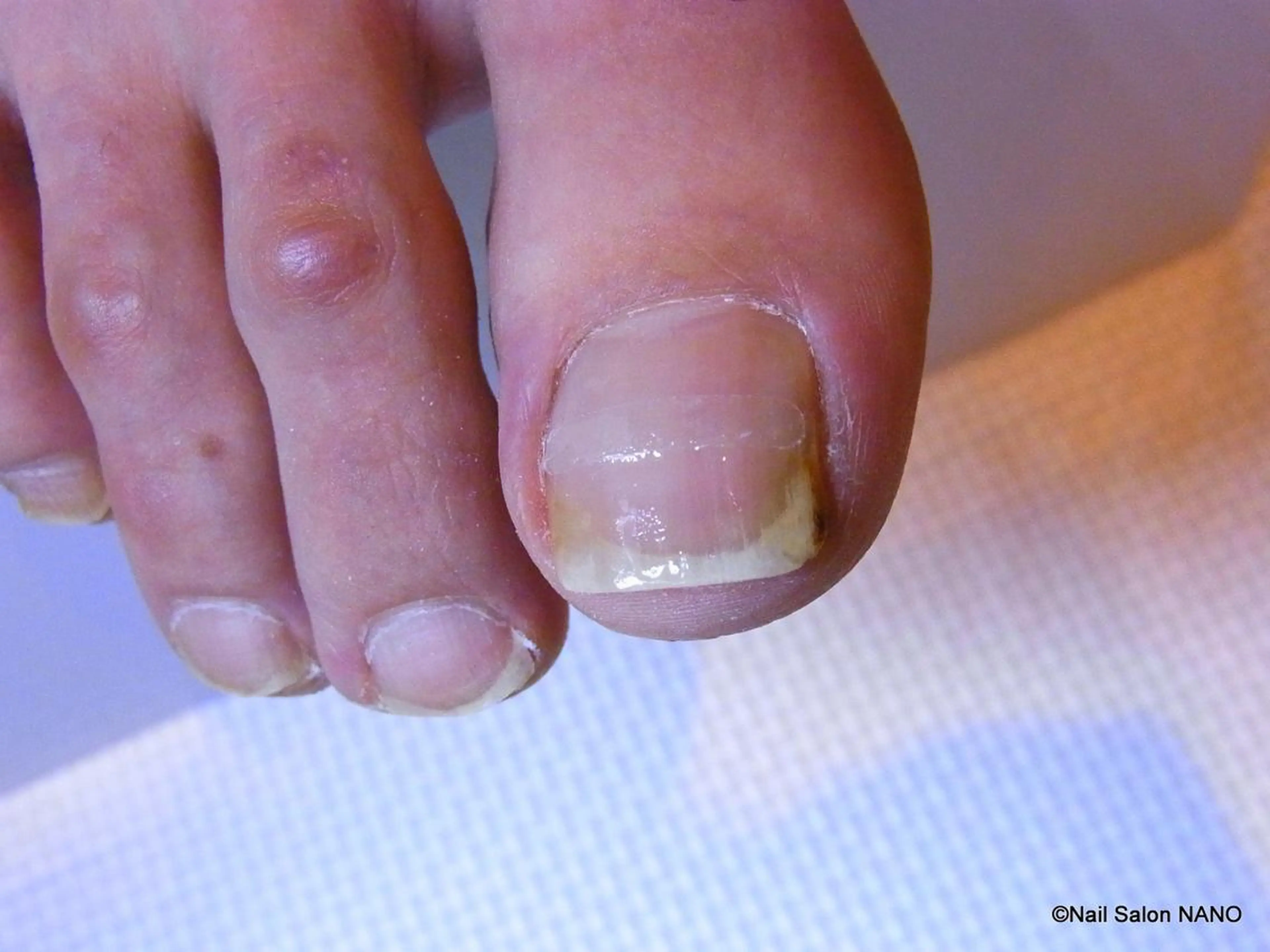 痛みを緩和する巻き爪矯正《BSブレイス》1本の写真