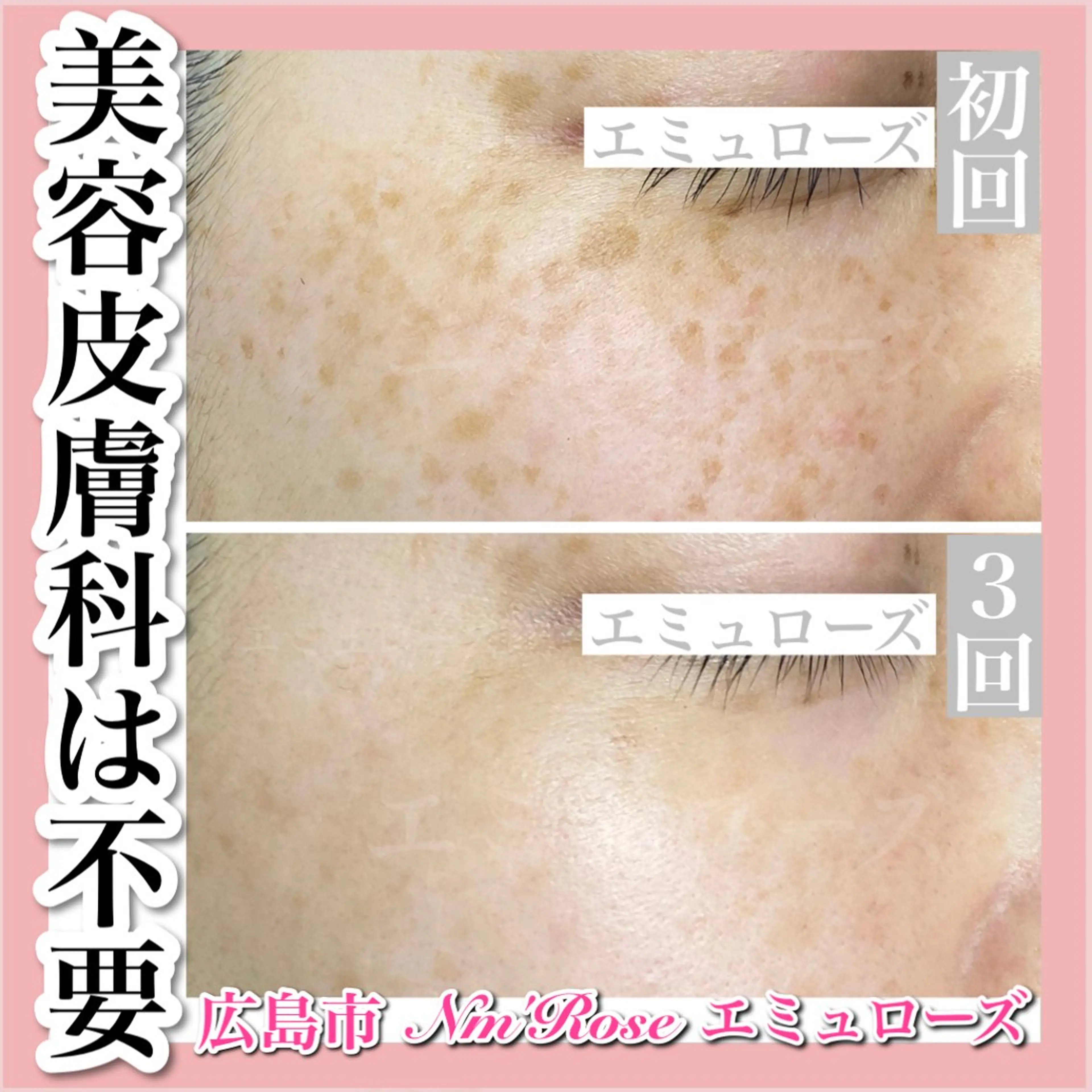 当店人気No. 1《光打ち放題》シミ・くすみ・ニキビなど肌悩み全解消！の写真