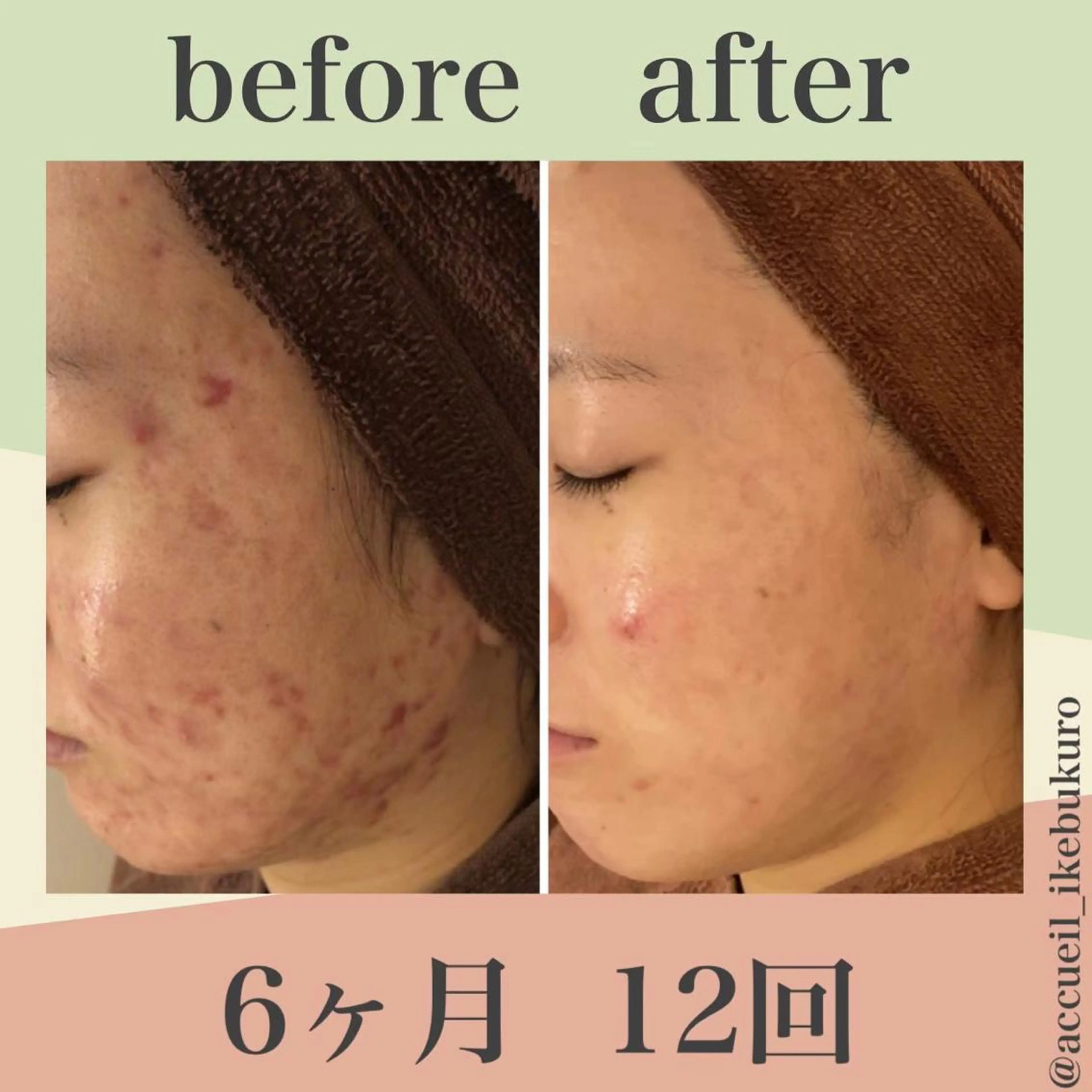 ミディアム カラー パーマ ヘアアレンジ メンズ キッズ ネイル マツエク・マツパ エステ リラク ニキビ・肌質改善専門 ♡人生が変わるサロンのエステ・リラクイメージ