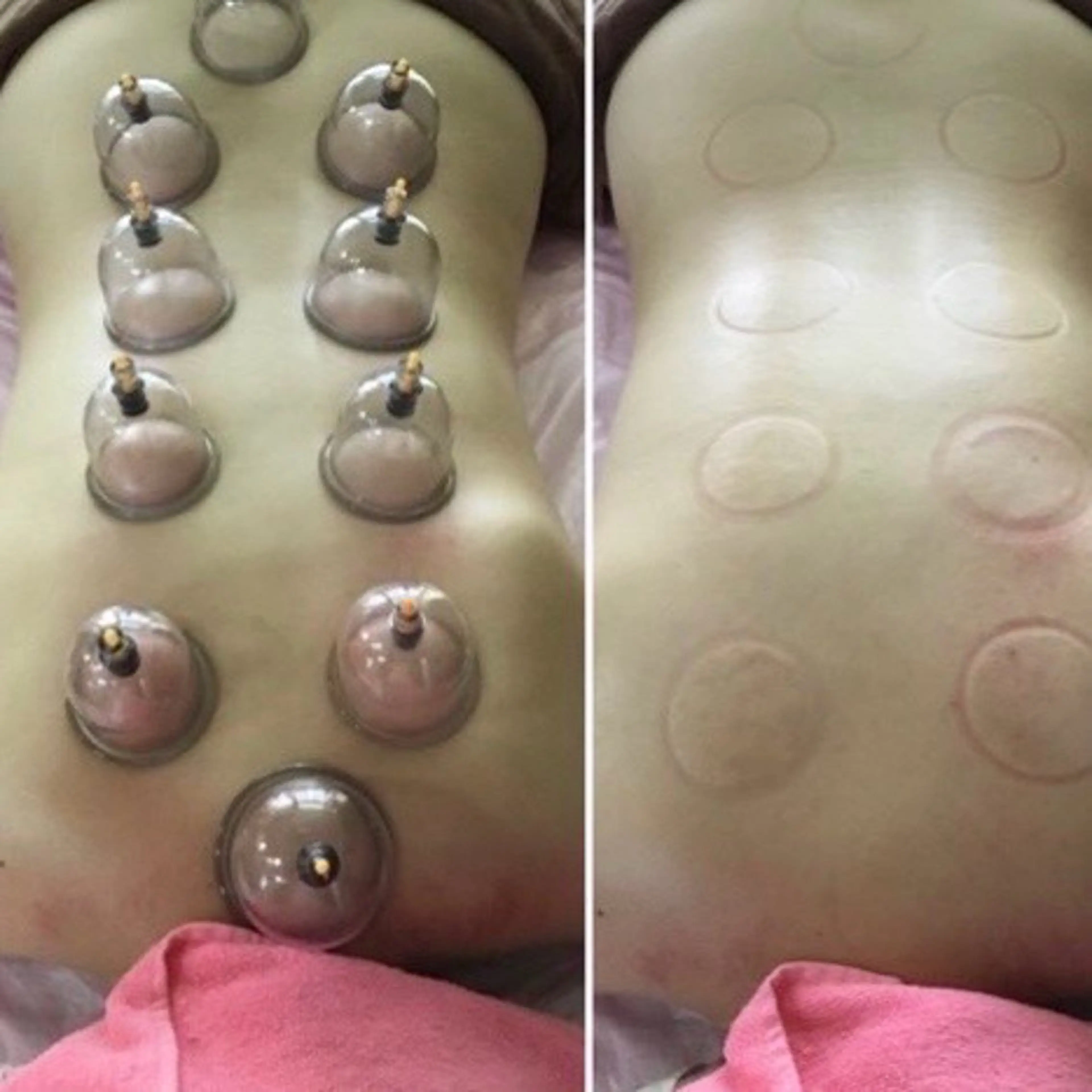 【2ヶ月集中】痩せたいチャレンジャー大募集！10回カッピング付きの写真