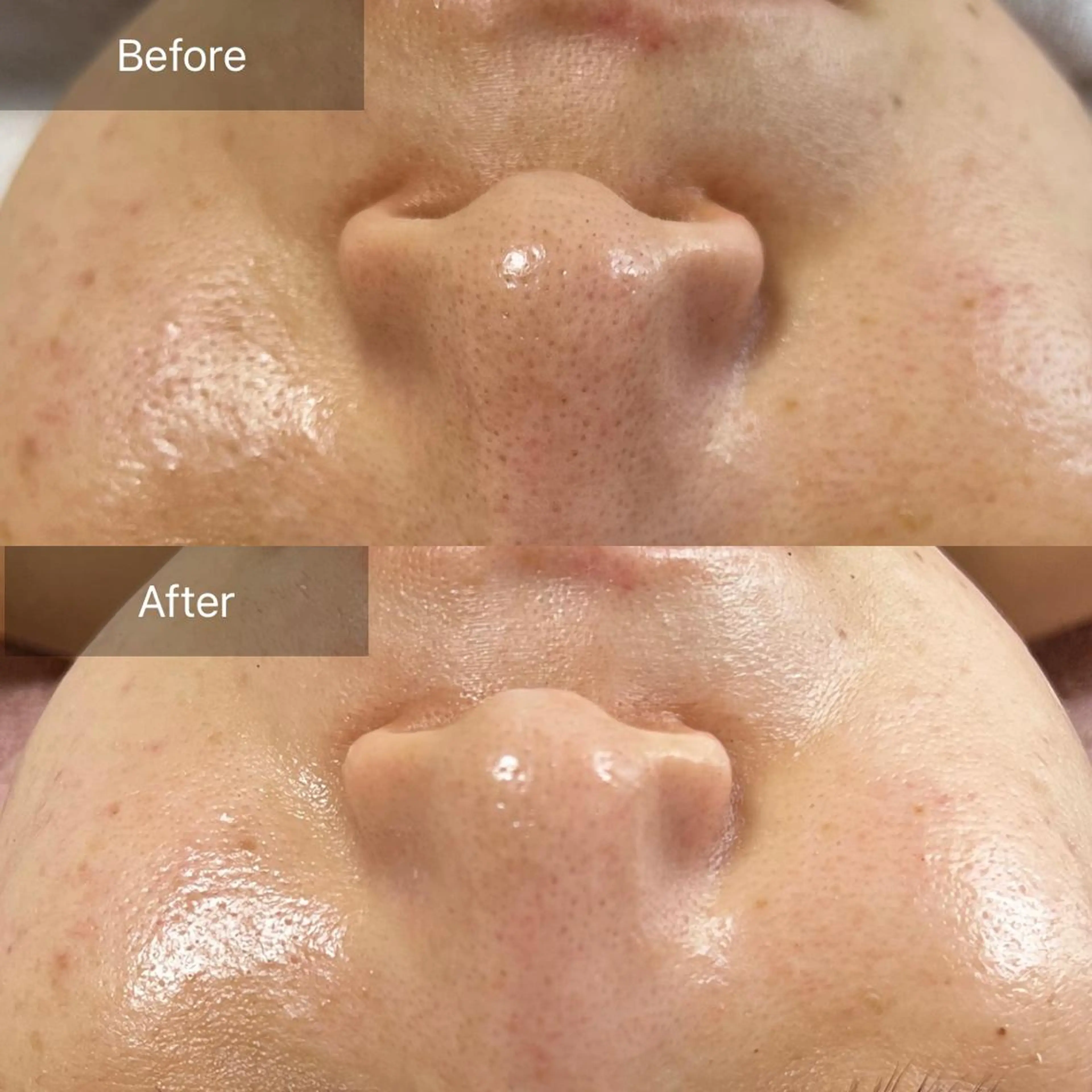 【ハーブピーリング】ツルツルたまご肌✨スッピンに自信がもてる❣️毛穴改善コースの写真