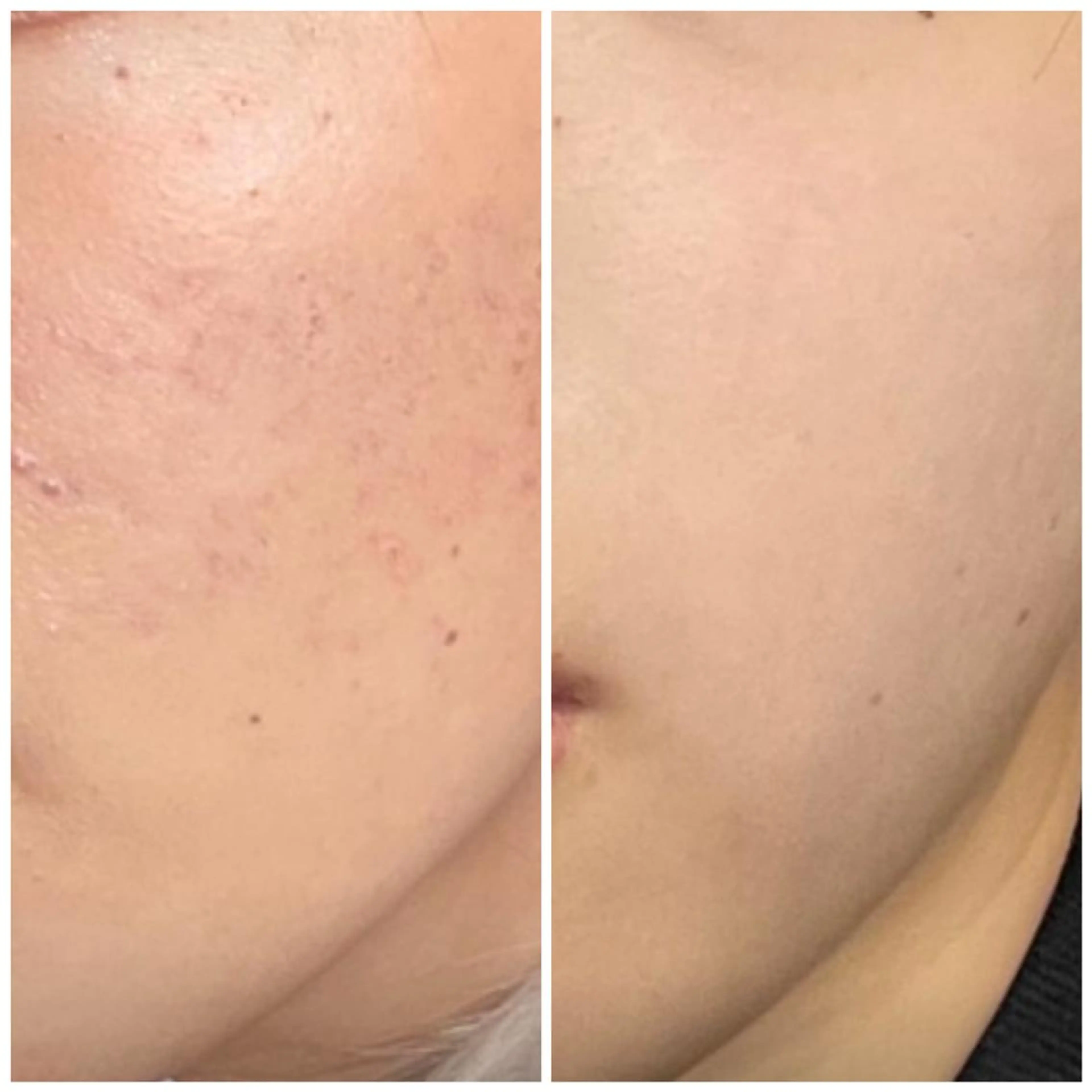 エステ リラク ニキビ特化型エステ 🍓最短で肌質改善のエステ・リラクイメージ