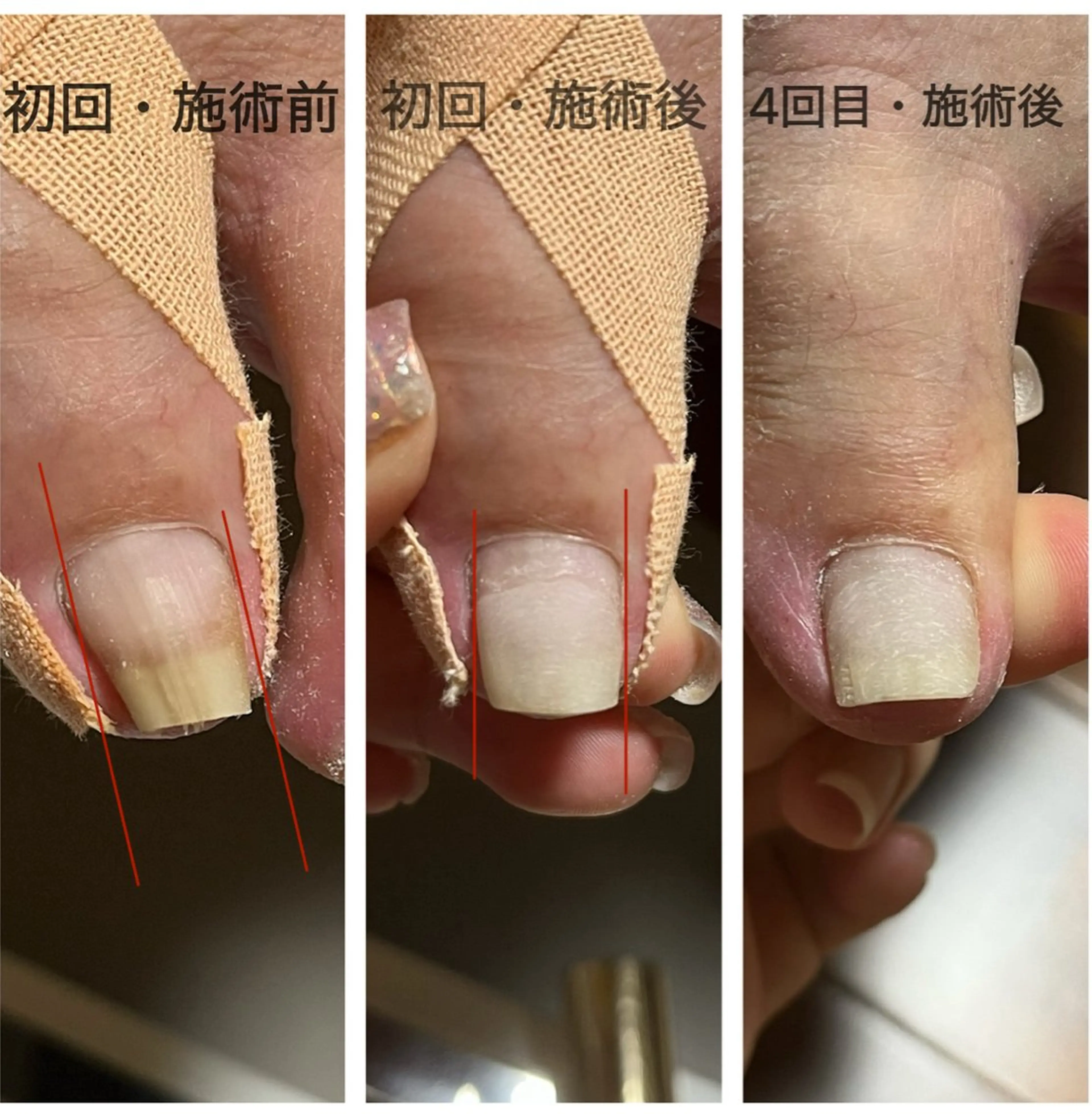 ネイル フットネイル ダンラップ新里 友簣乃のネイルデザイン