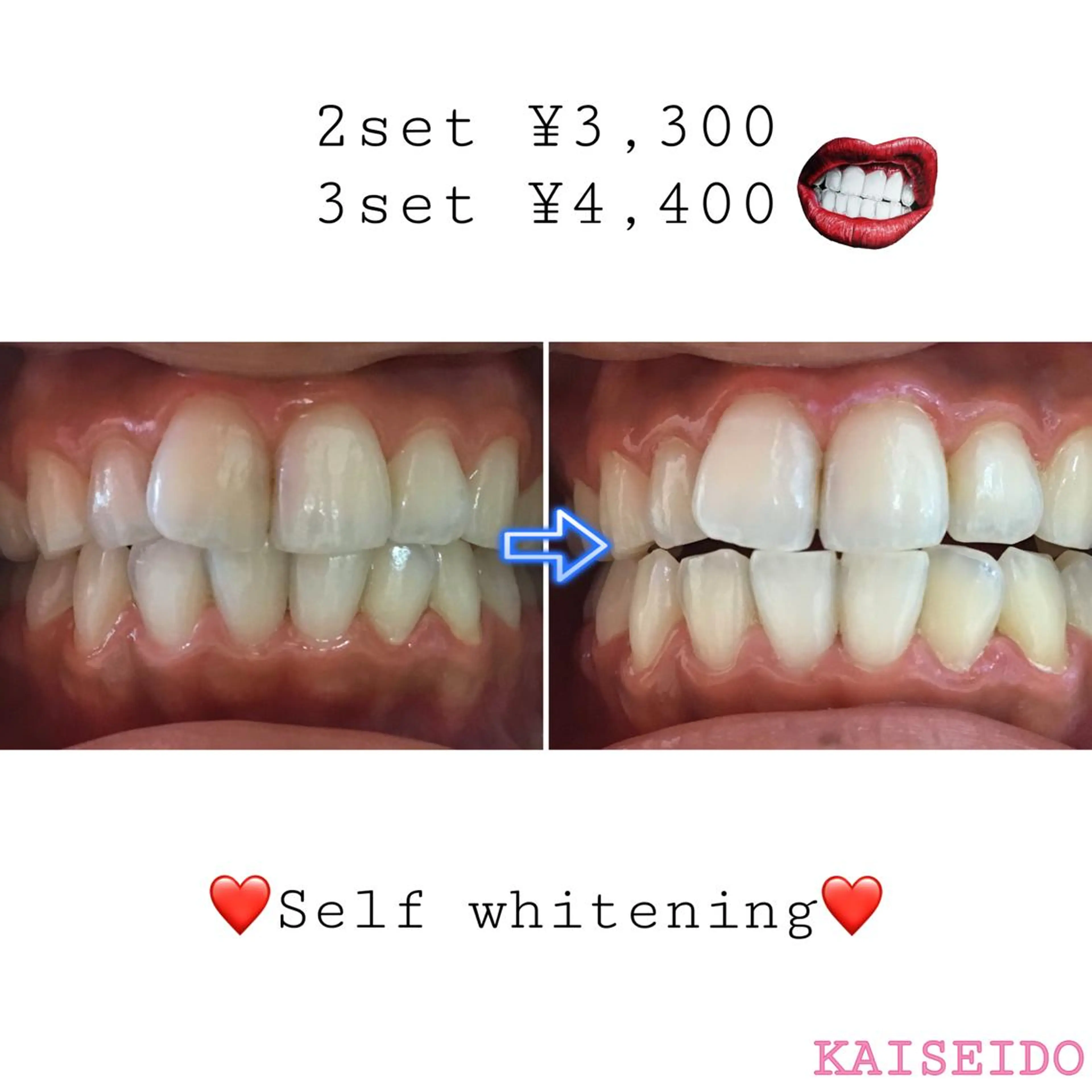 【セルフホワイトニング🦷】LED照射15分2セットのコースとなります。初回限定歯ブラシ&マウスオープナープレゼントの写真