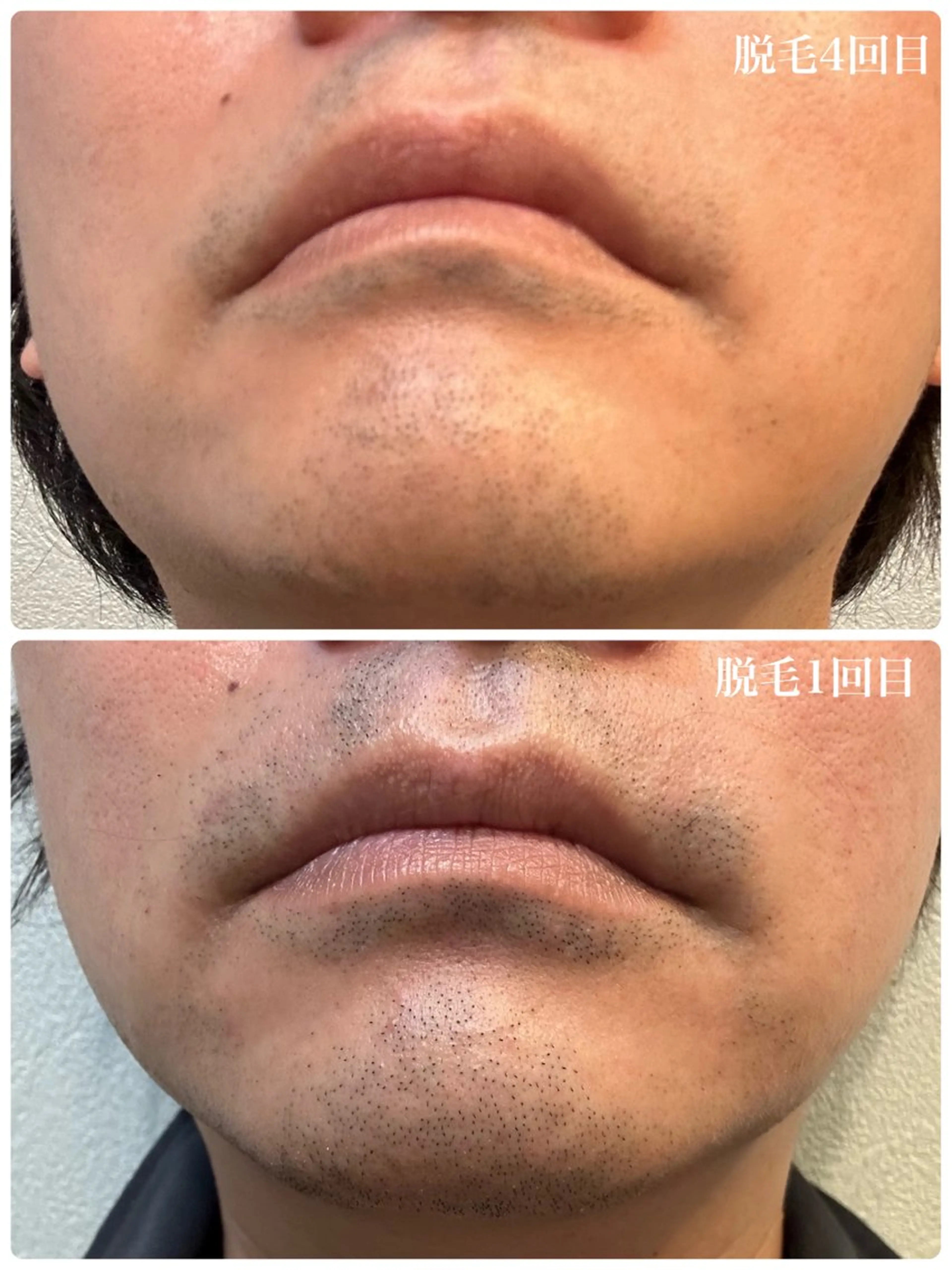 【minimoメンズ限定】メンズカット＆ヒゲ脱毛の写真