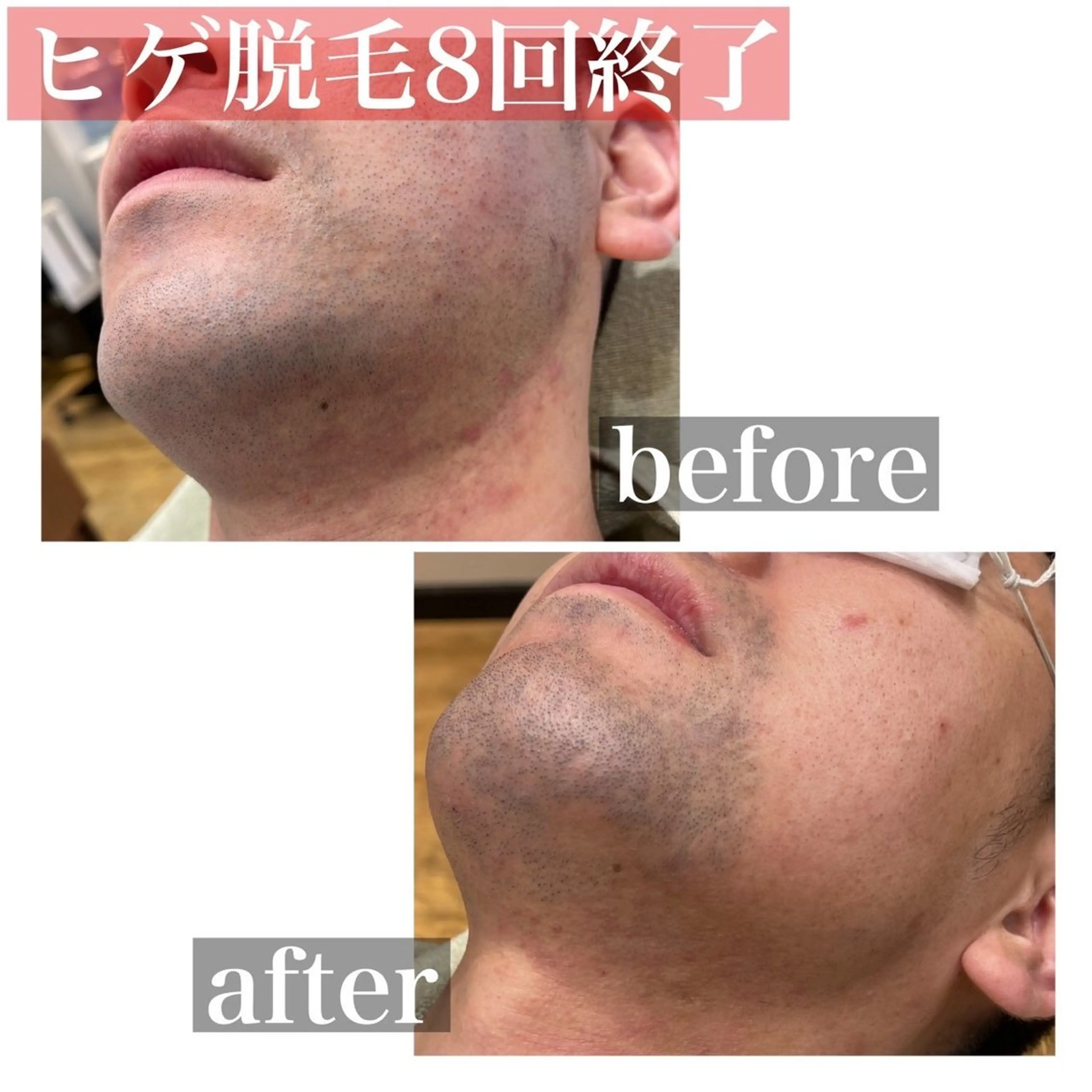 脱毛 HAIRS YOSHIOKA所属・ヘアーズヨシオカ MENSヒゲ脱毛のエステ・リラクイメージ