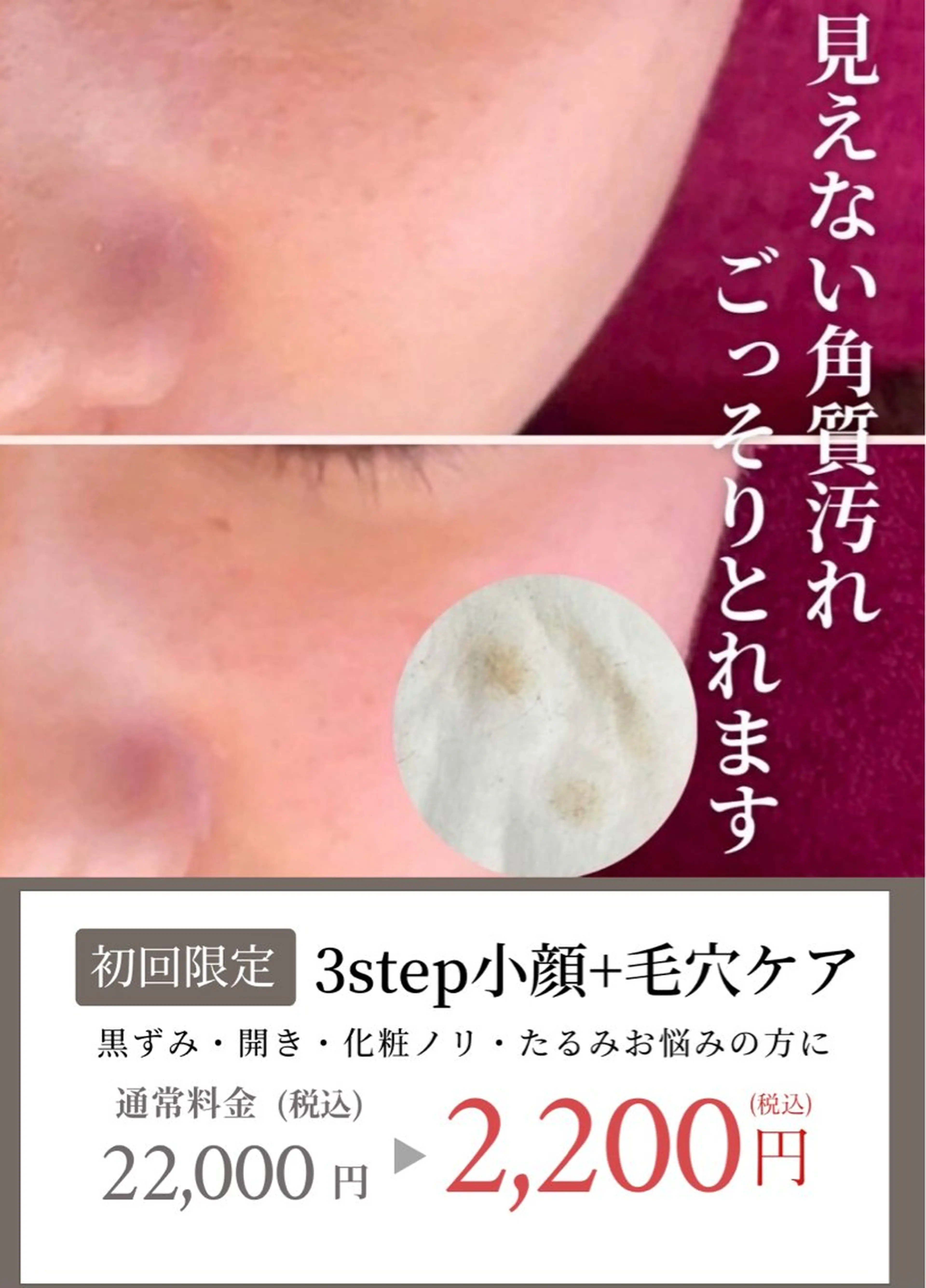 3step小顔+【毛穴ケア】見えない角質汚れもごっそりとれるクレンジング付 100min ¥22,000→¥4,300の写真