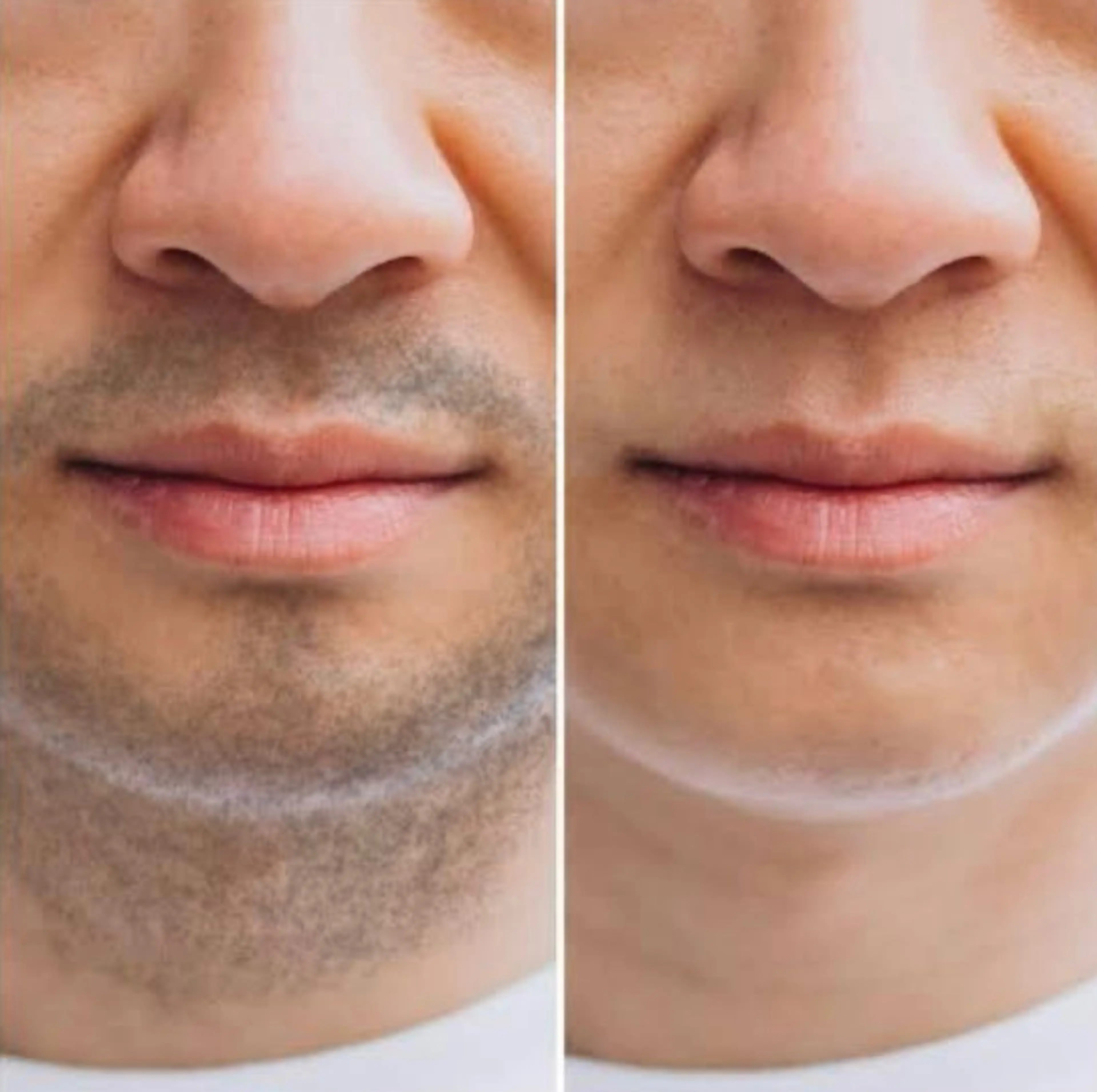 ハイブリッド美肌脱毛Pパーツ（men’s）口周り・指・へそ周り・顎などの写真