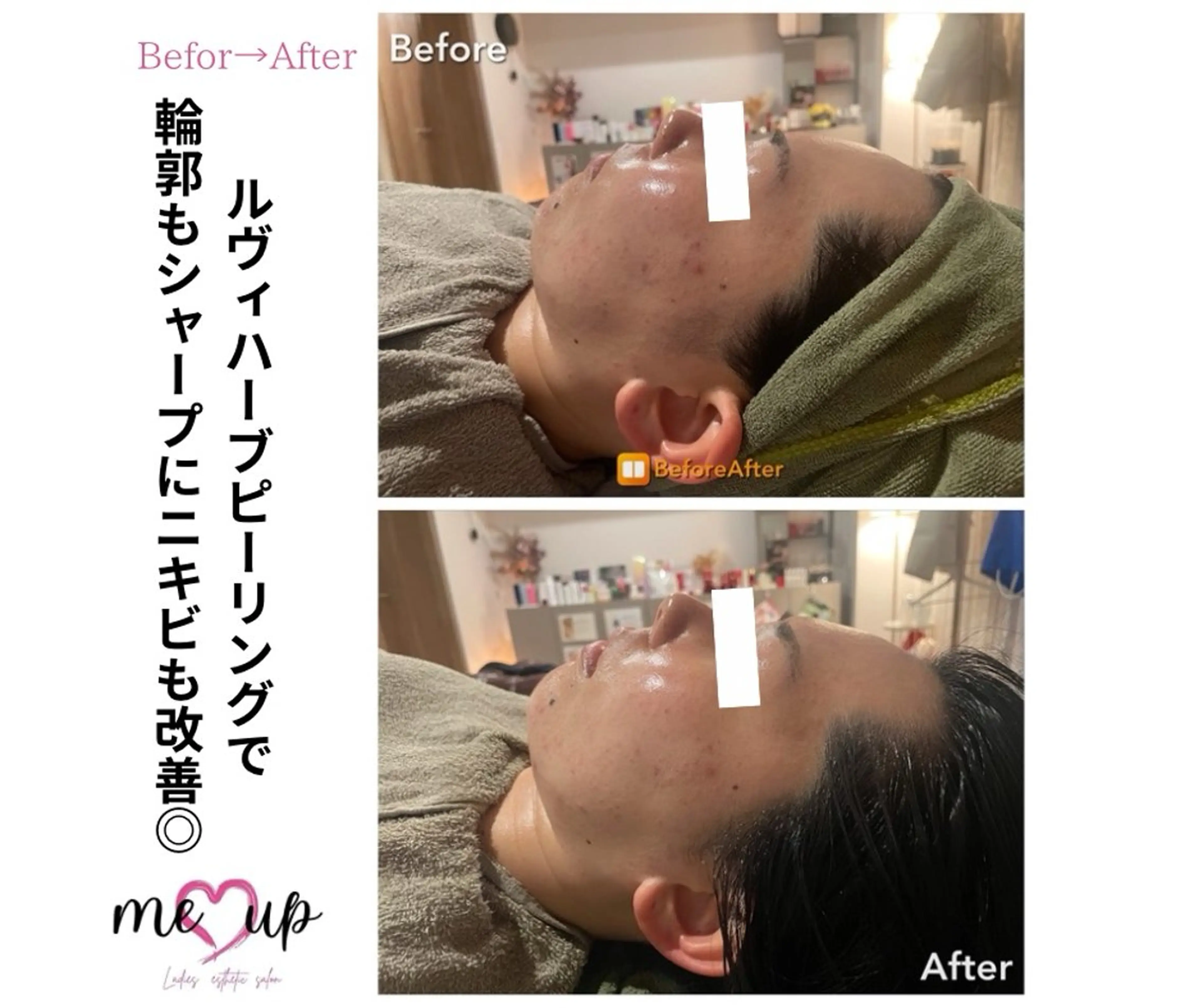 エステ Meupニキビ専門店 背中/ハーブ/肌管理のその他イメージ