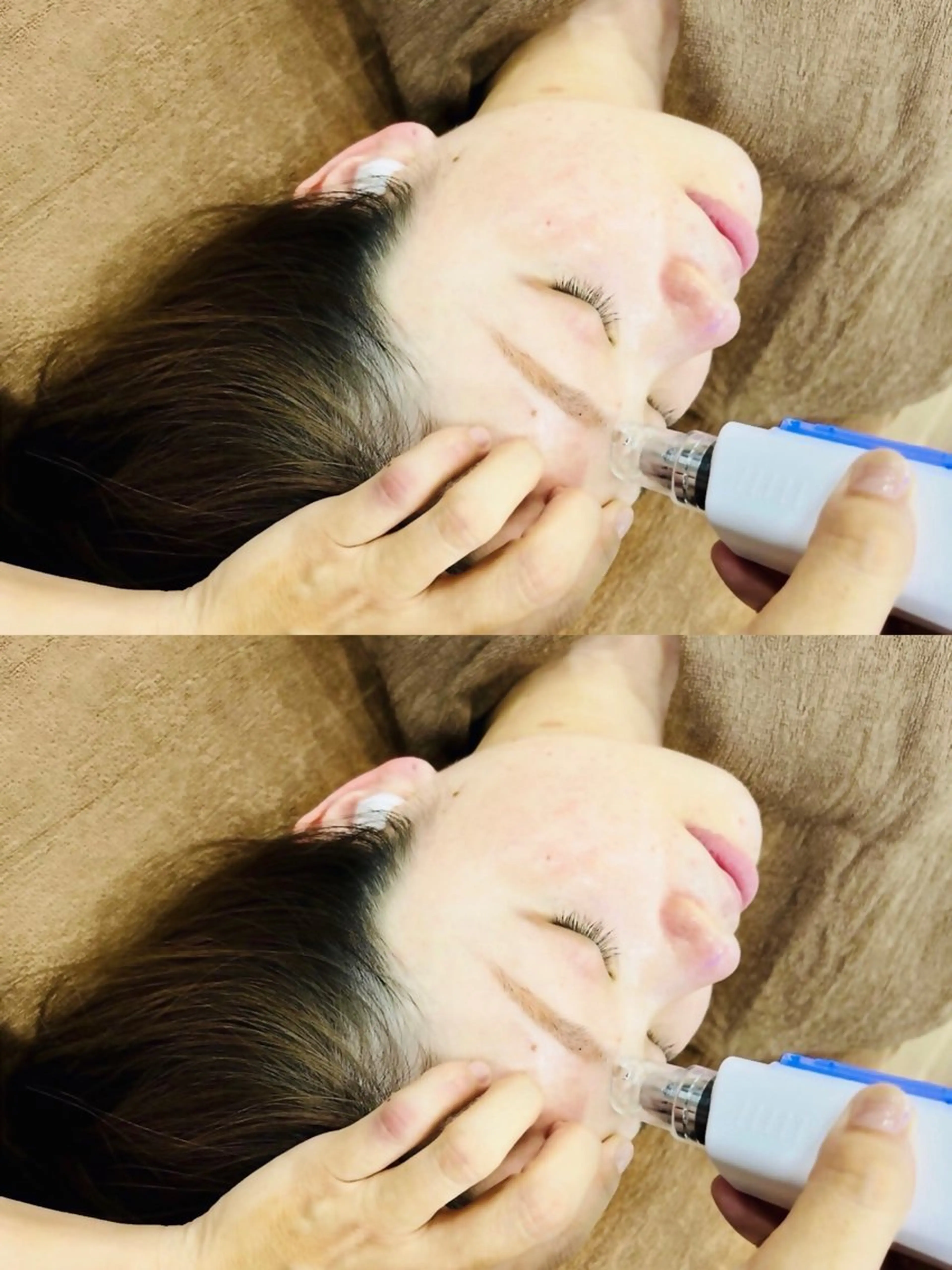 【人気🔥】針なし水光針+EXO+ダウンタイムなし<即日実感> 🔸美容成分 23倍の浸透💉🔸の写真