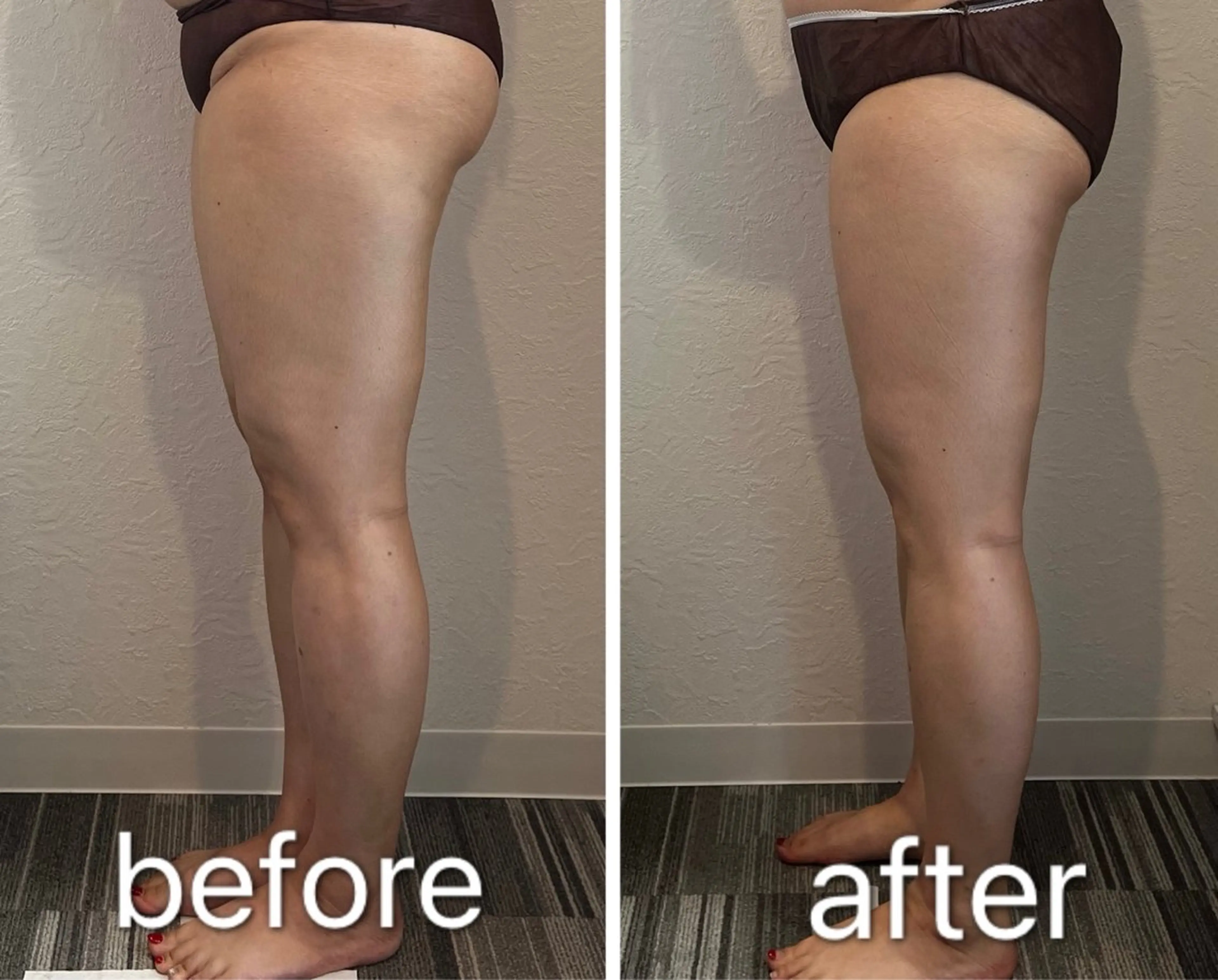 【痩身/下半身痩せ美脚】美骨盤矯正+ハイパーナイフ+電磁パルス75分の写真