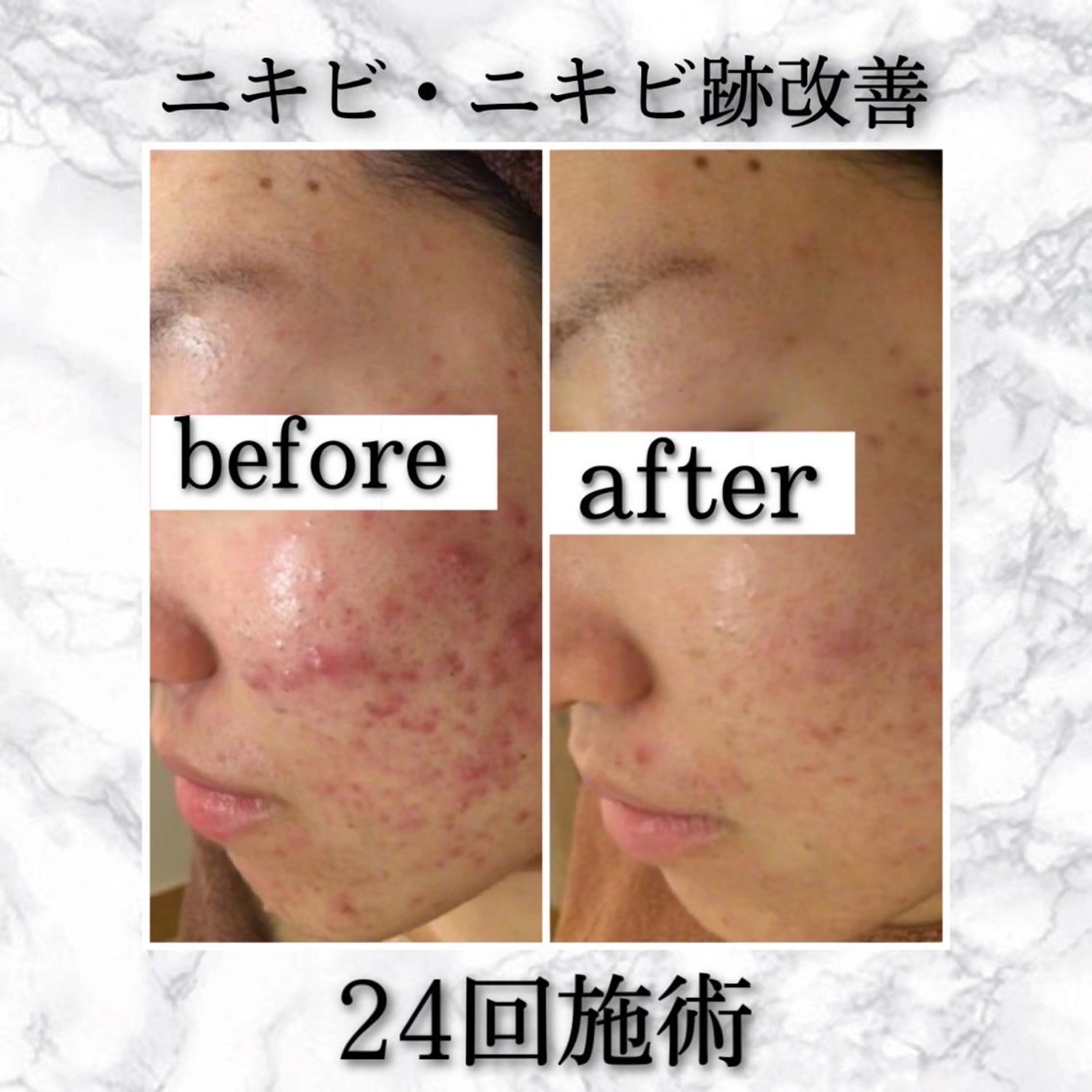 ショート カラー パーマ ヘアアレンジ メンズ キッズ ネイル マツエク・マツパ アイブロウ 赤色 夏までに肌荒れ卒業 するサロン🌻のエステ・リラクイメージ