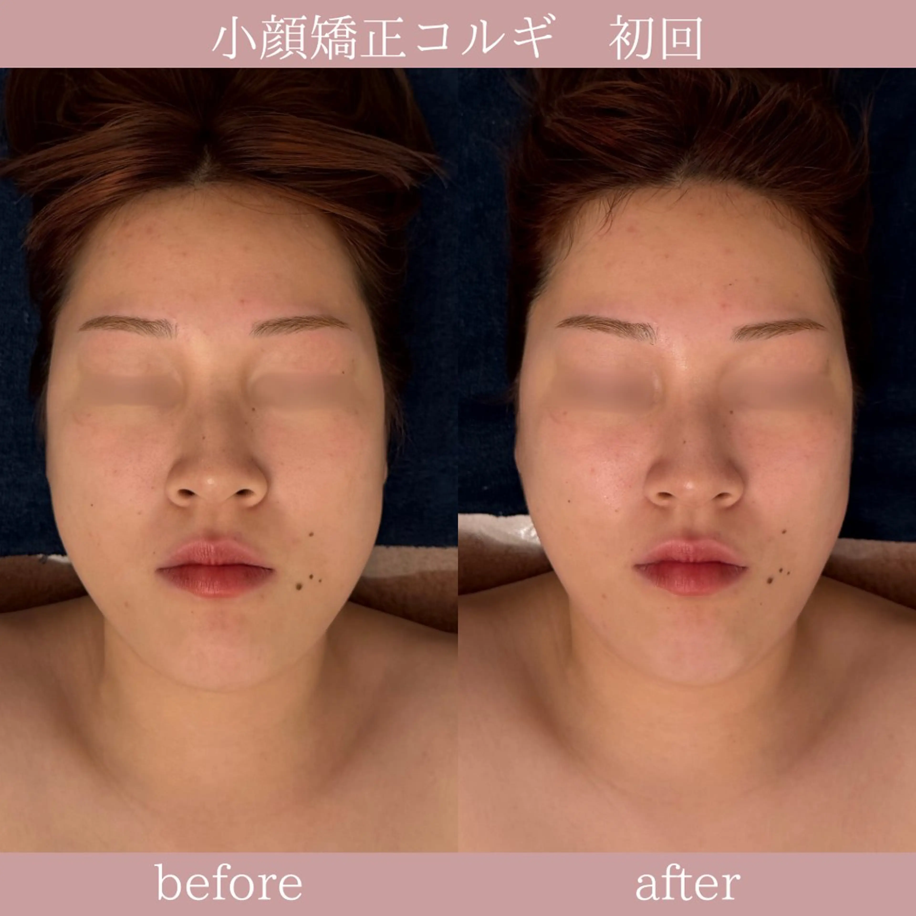 ㊗️成人式の方限定👘✨️小顔矯正コルギ＋上半身ほぐし付👏✨韓国アイドル顔🇰🇷《エラ張り・ハチ張り◎》の写真