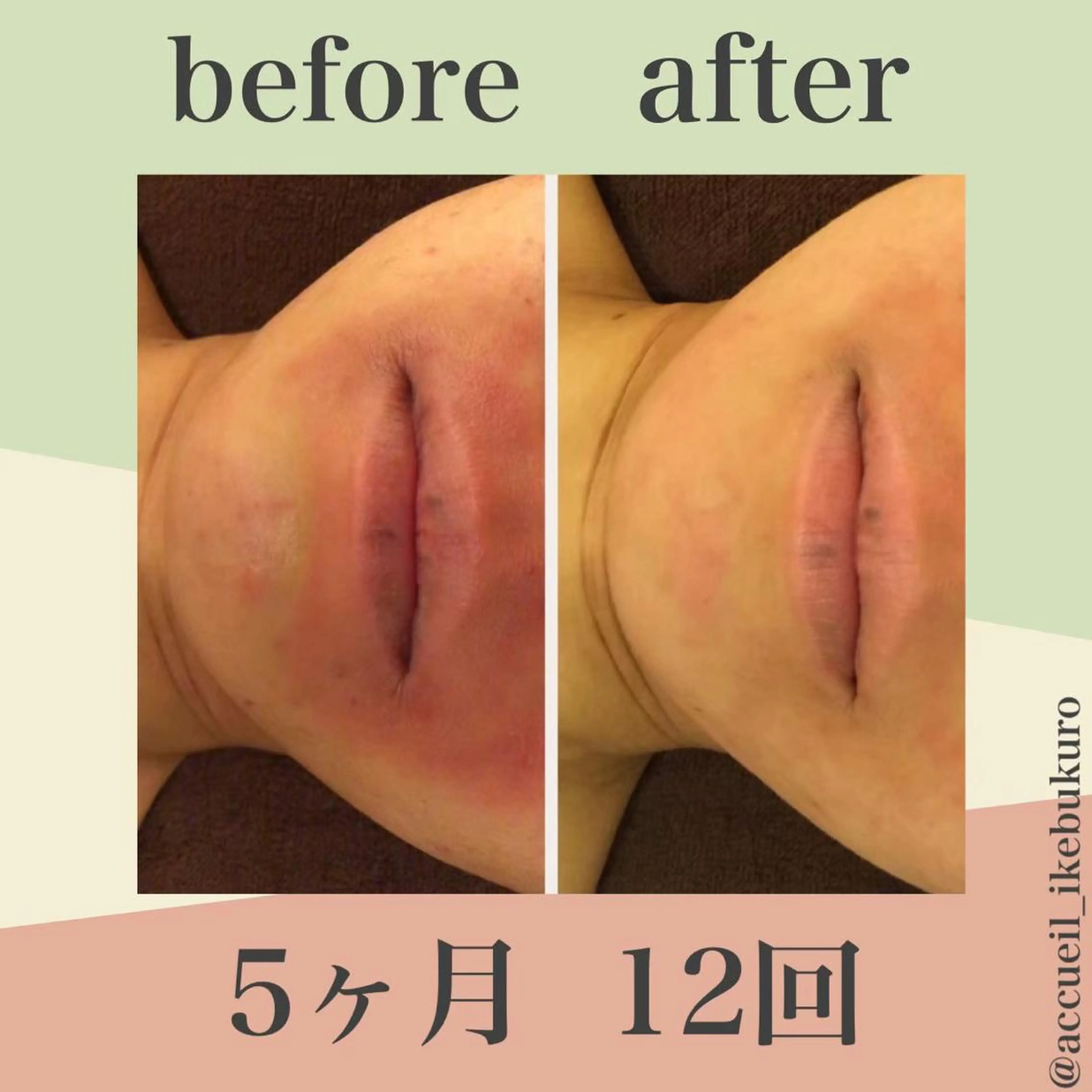 ミディアム カラー パーマ ヘアアレンジ メンズ キッズ ネイル マツエク・マツパ エステ リラク ニキビ・肌質改善専門 ♡人生が変わるサロンのエステ・リラクイメージ