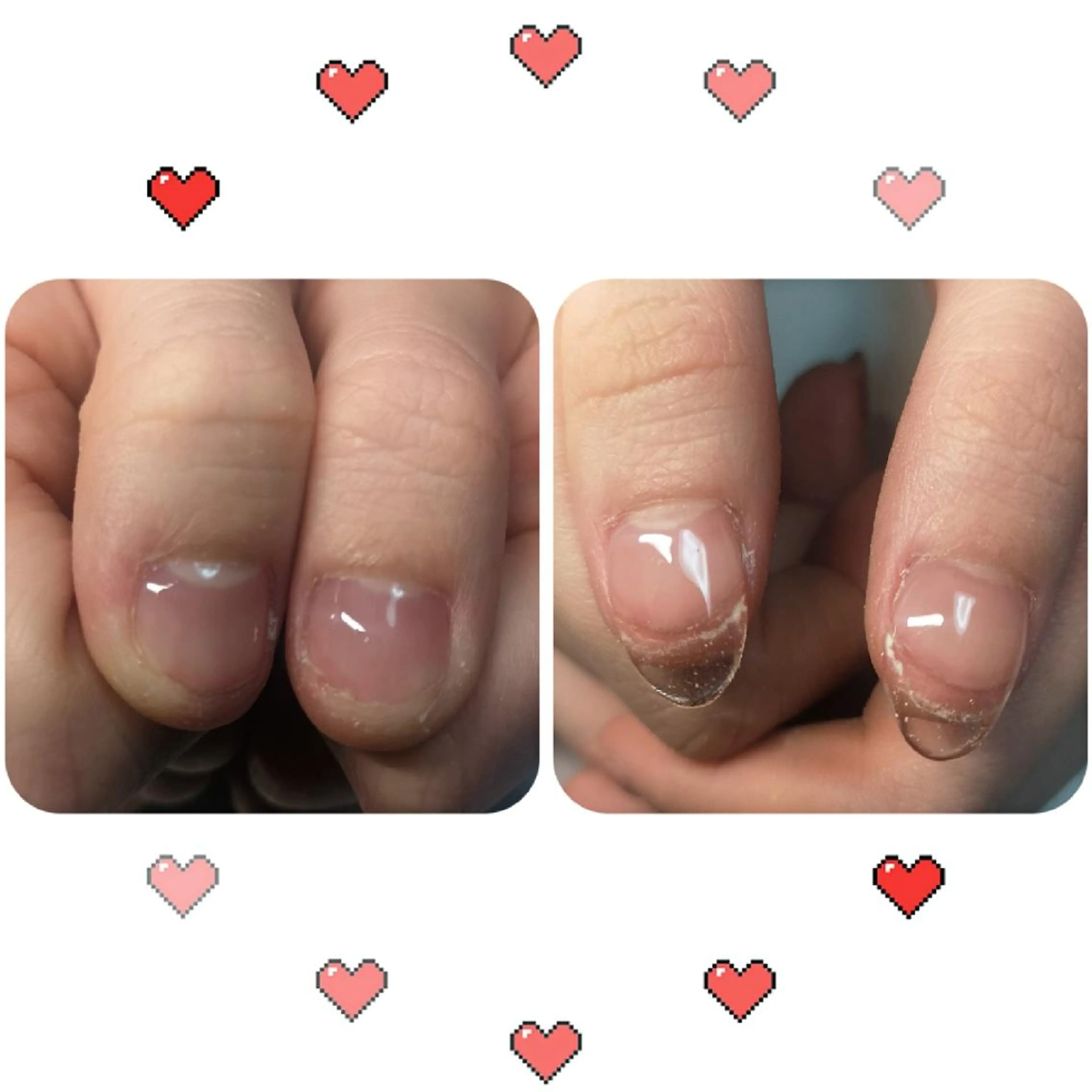 ショート ネイル ネイリストゆか💅 長さだし、深爪矯正のネイルデザイン