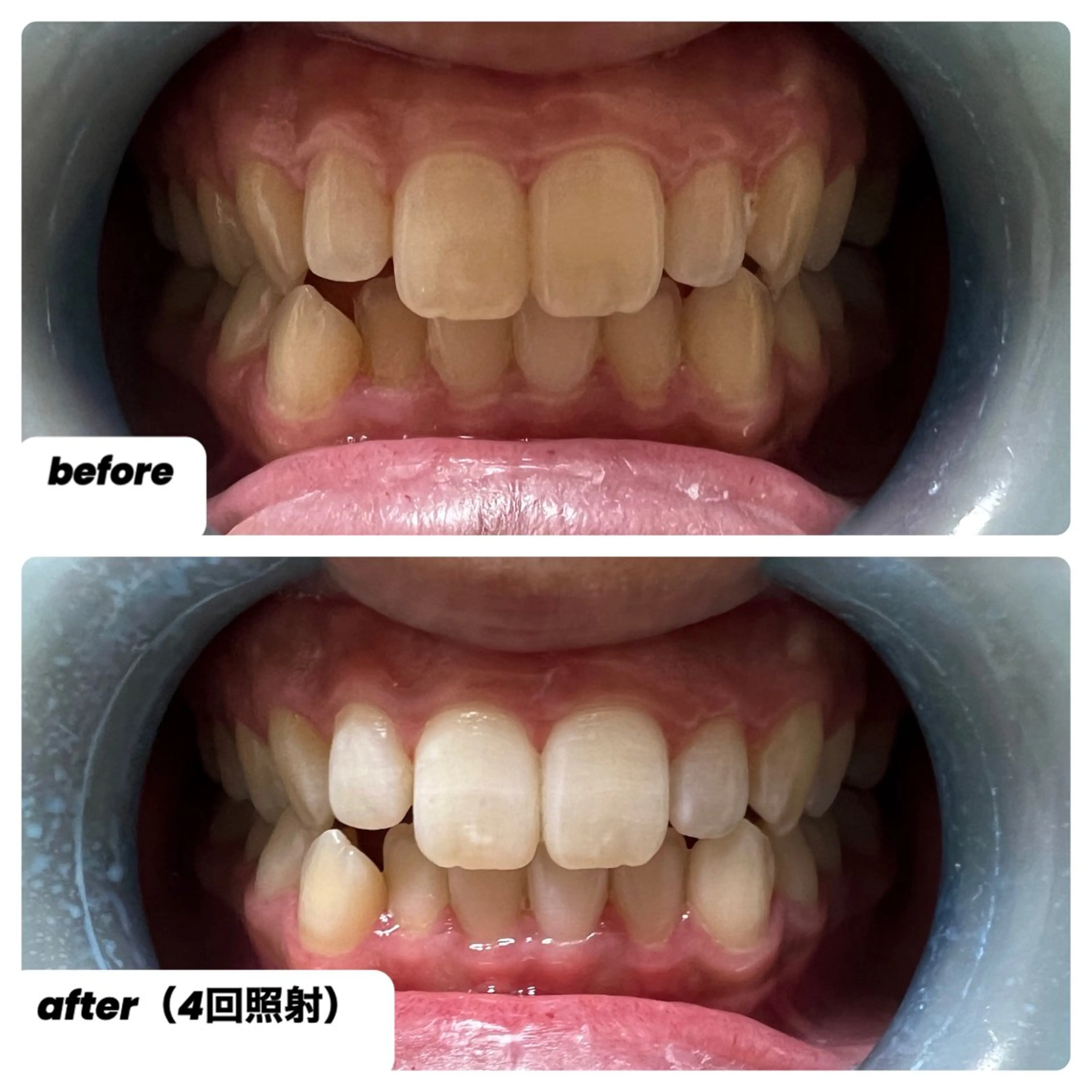 セルフホワイトニング1回の写真