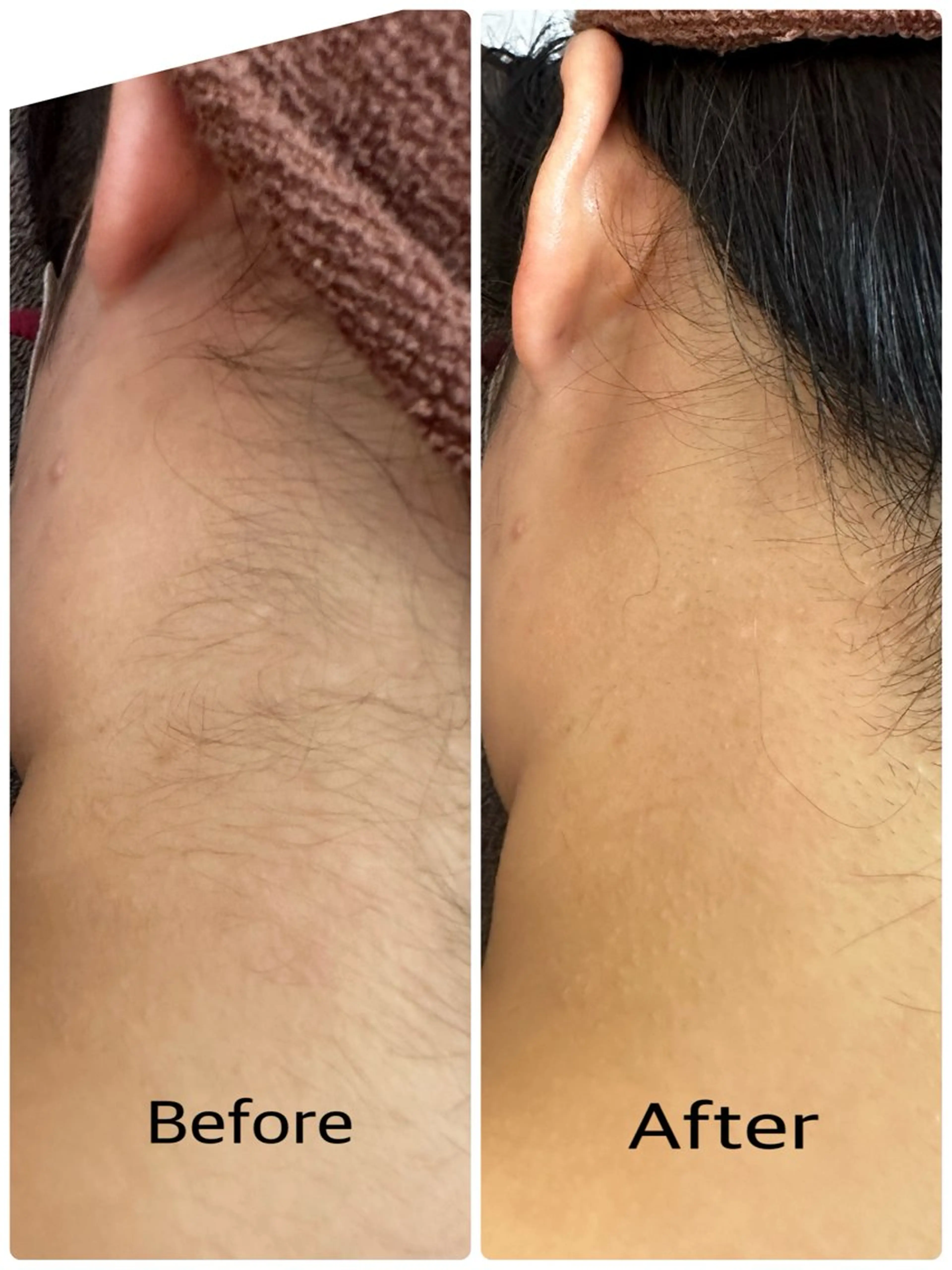 脱毛 桐山 まどかのその他イメージ