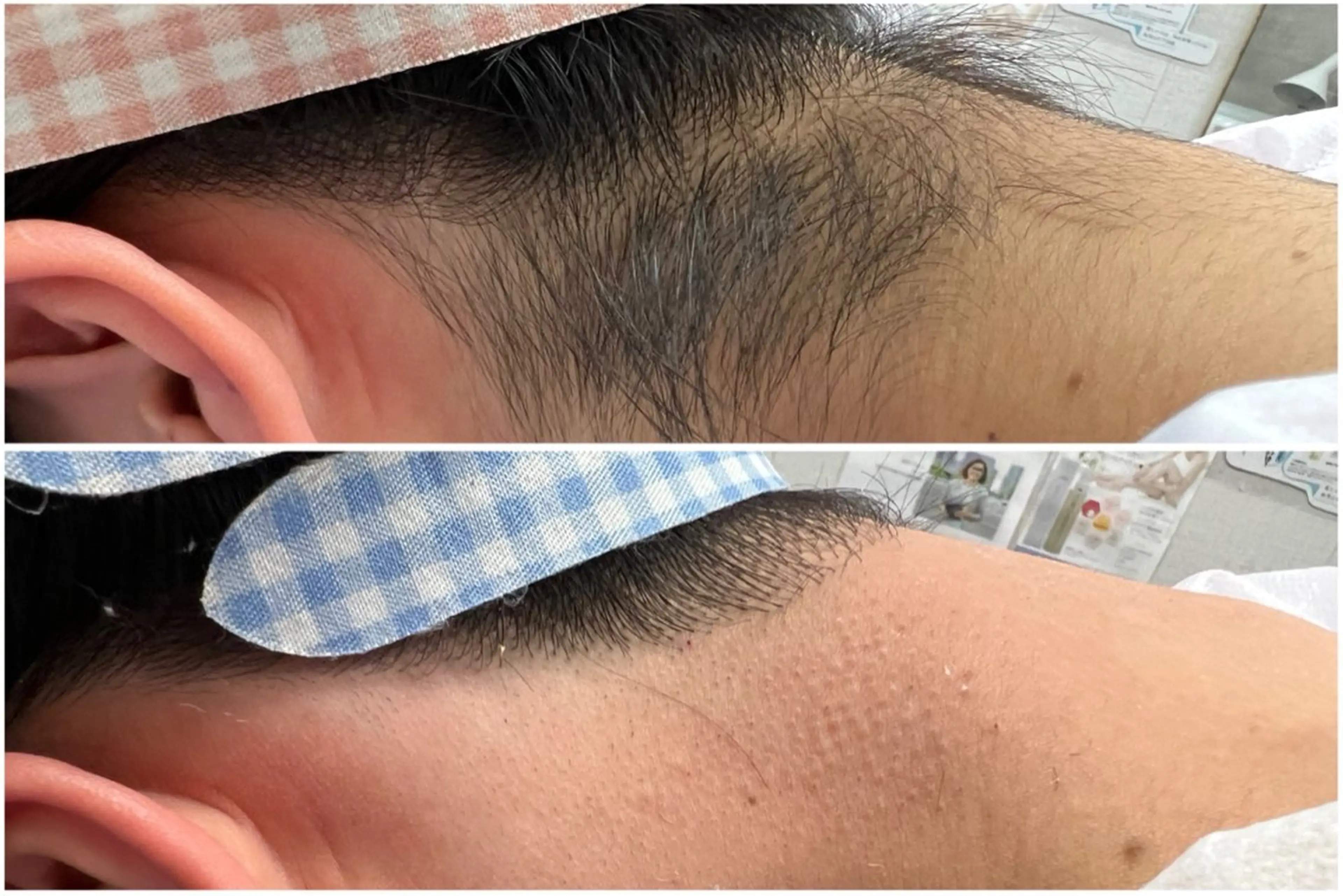 【再来】うなじ脱毛◆ワックス＋光脱毛で仕上がり&効果◎¥4980の写真